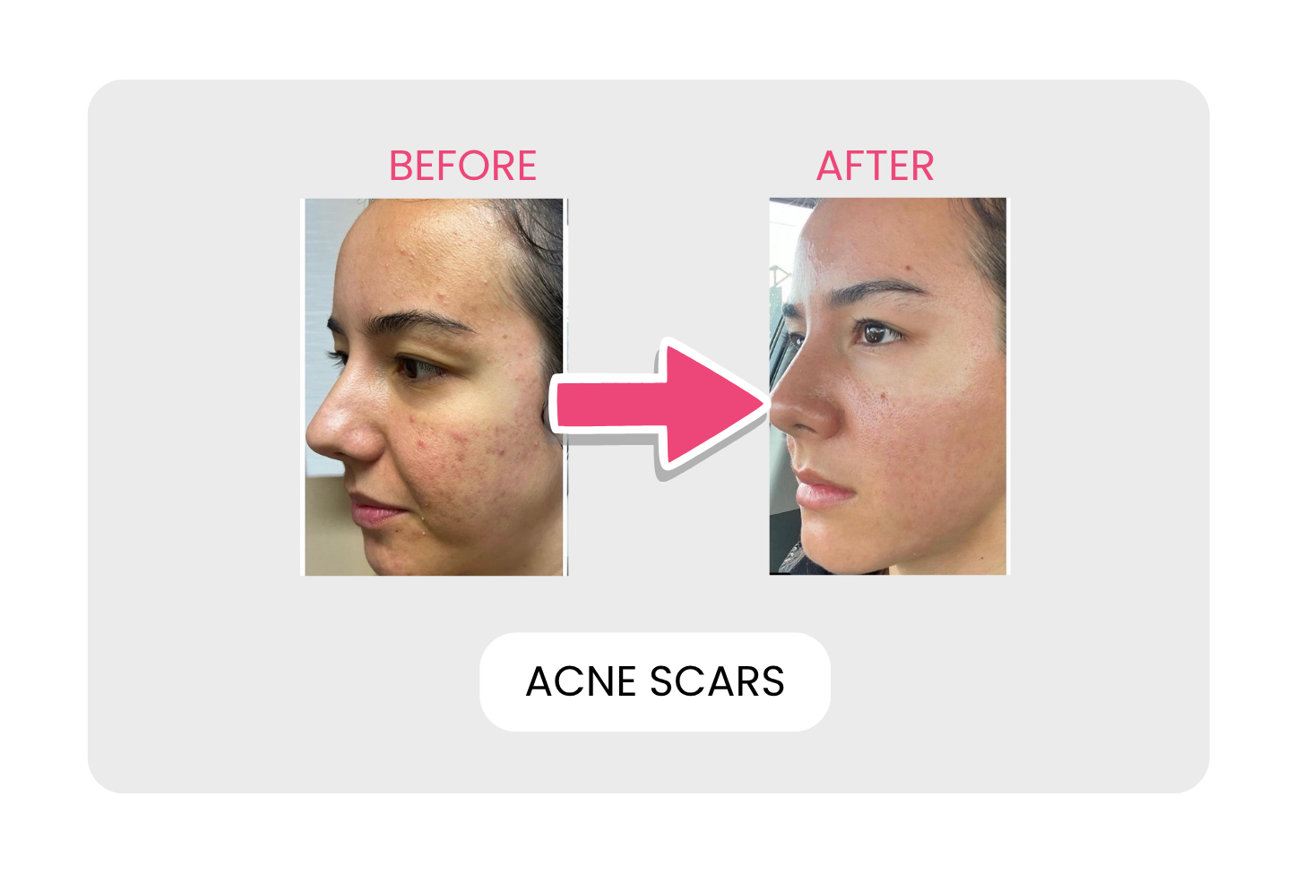 Acne scars before and after