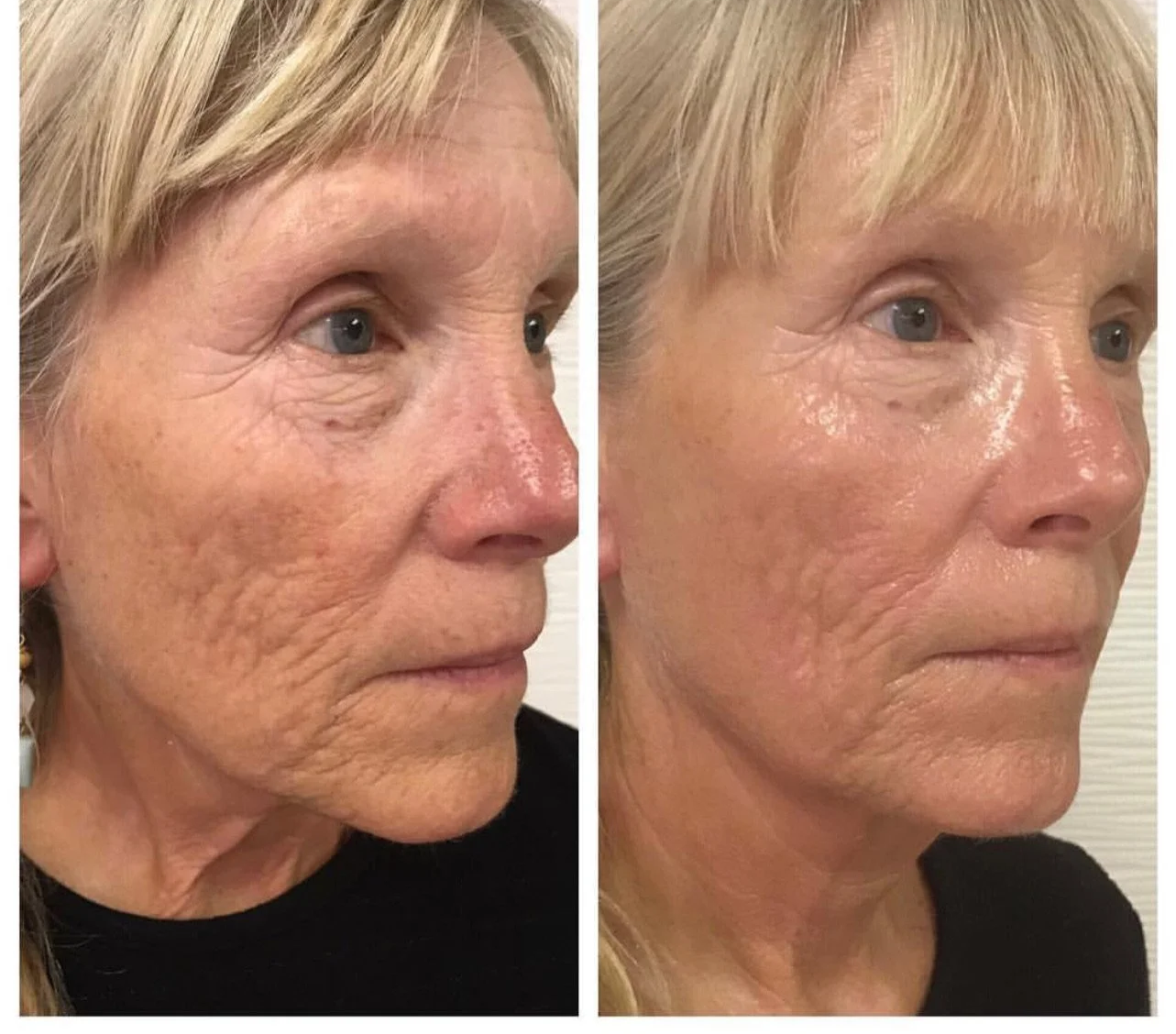 Anti-aging facial before and after at Kiwi Spa San Diego