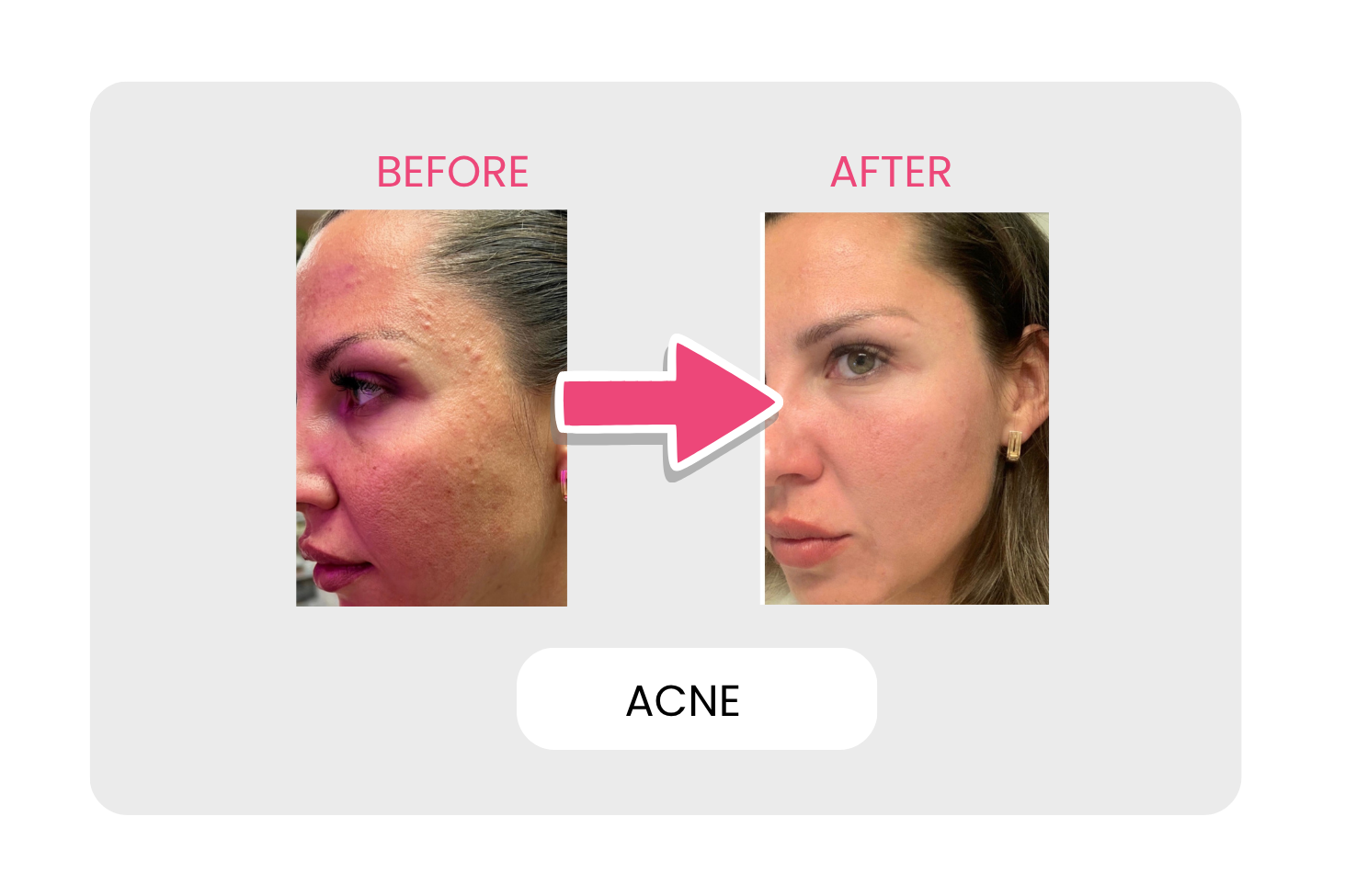 Acne before and after