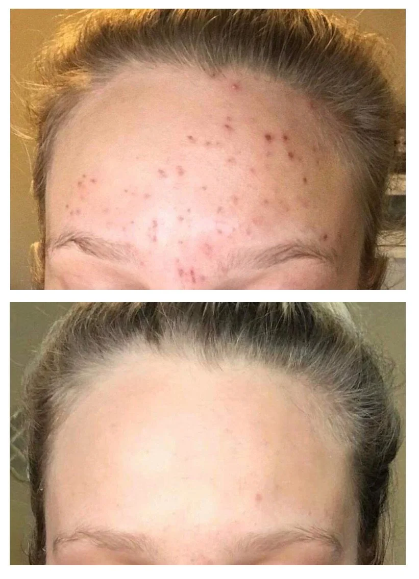 Before and after photos of acne facial client at Kiwi Spa San Diego