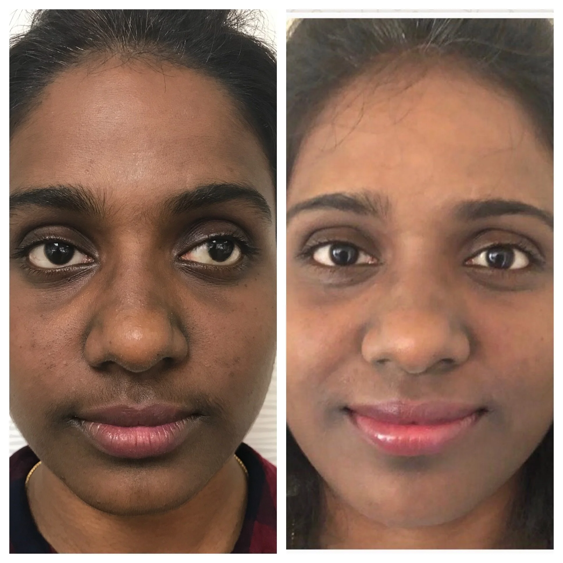 Side-by-side comparison of a woman's face showing skin improvement, with redness and blemishes on the left and clearer skin on the right.