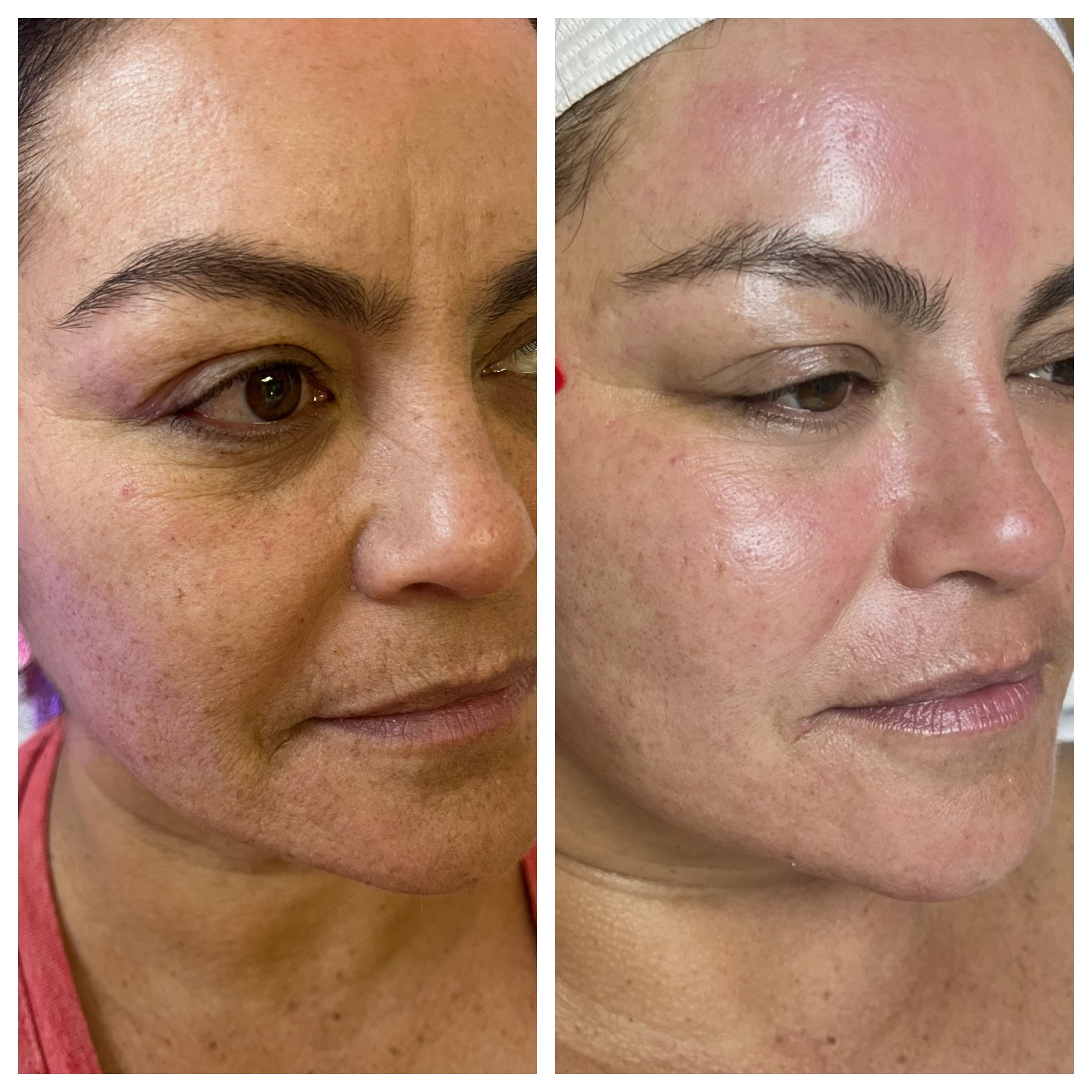 Before and after comparison of a woman's face showing skin improvement, reduced blemishes, and smoother complexion.
