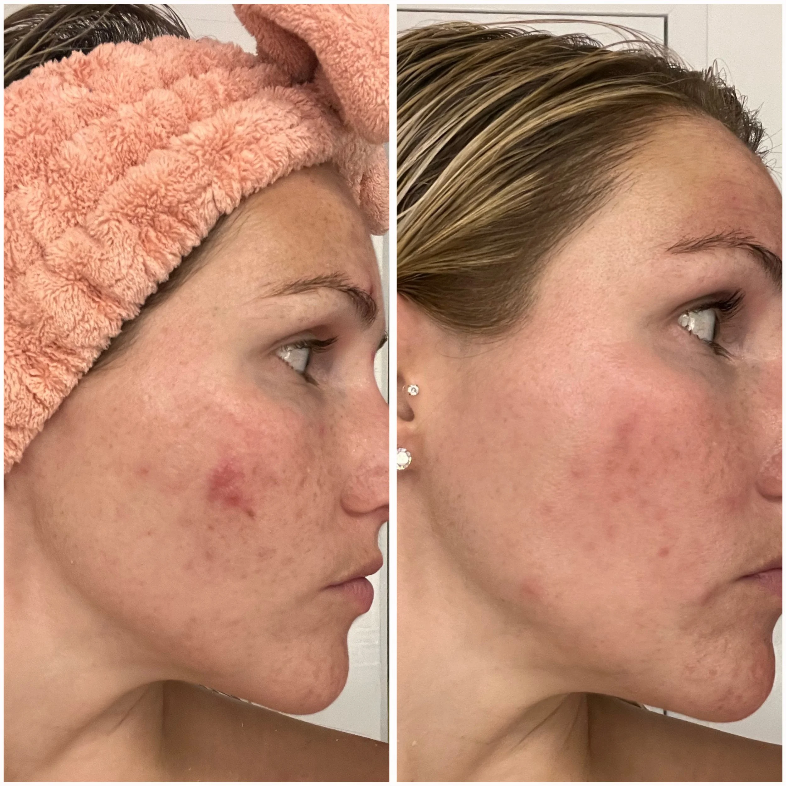 Before and after comparison of skin improvement, showing reduction in acne and clearer complexion on a woman's face.