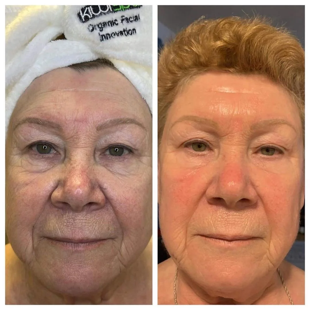 Comparison of a woman's face showing skin with acne scars before and after skin treatment, with clearer skin in the after photo.