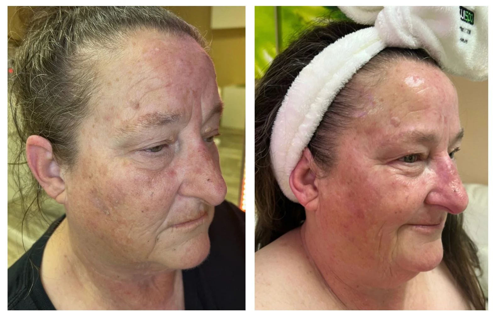 Before and after facial treatment showcasing improved skin texture and reduced wrinkles on an older person.