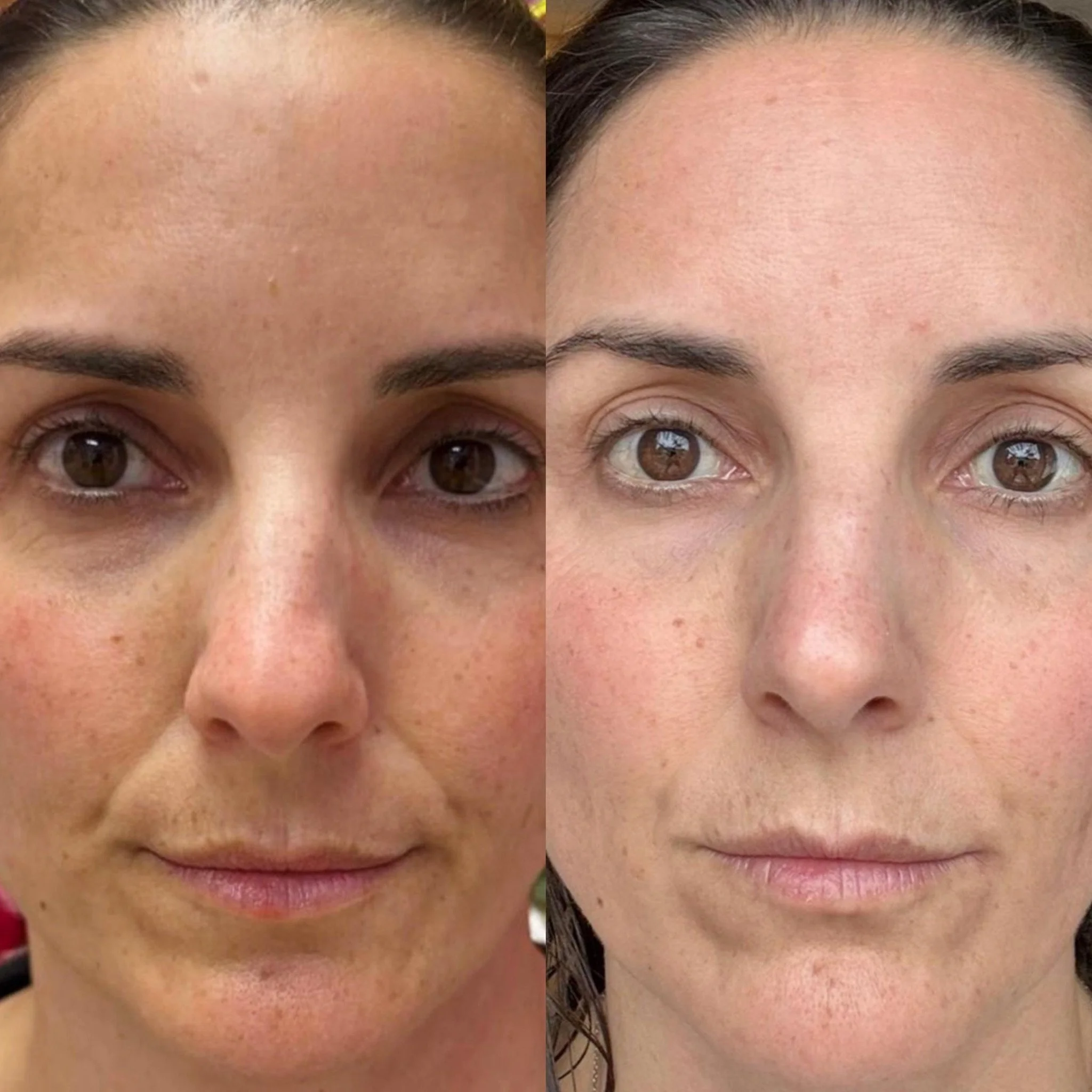 Anti-aging facial treatment