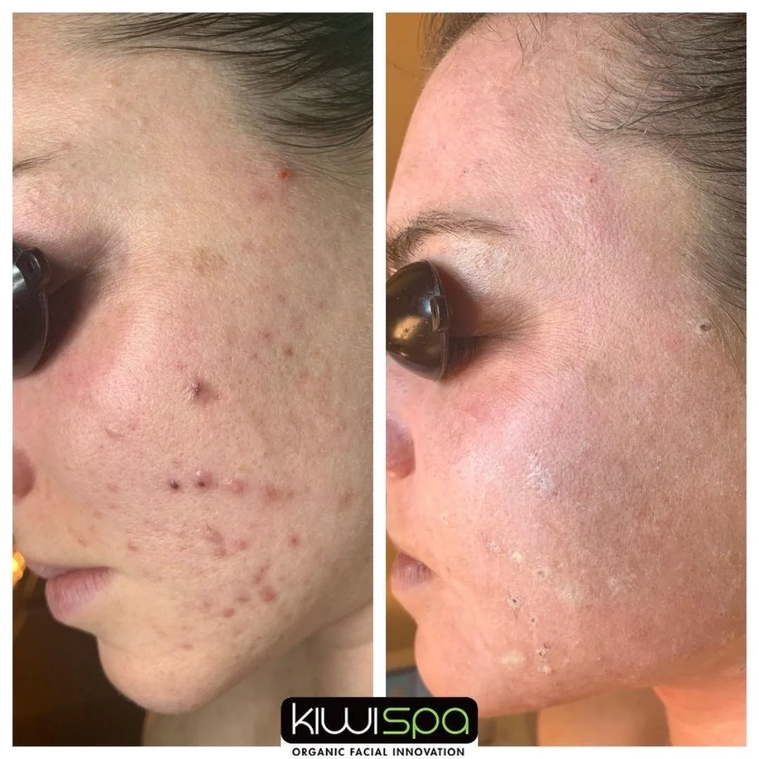 Kiwi Spa Pacific Beach acne results