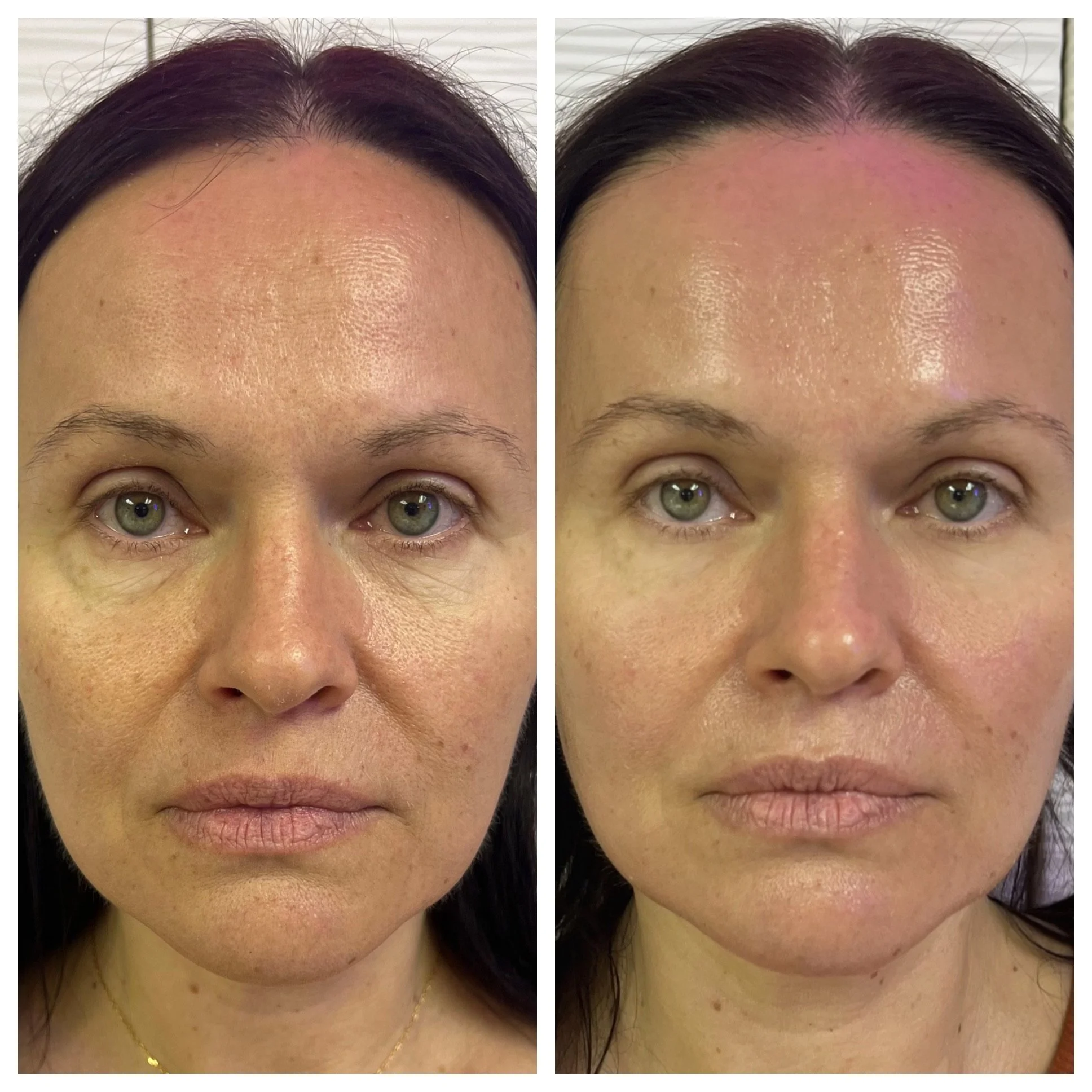 Before and after comparison of a woman's face showing skin improvement, reduced blemishes, and smoother complexion.