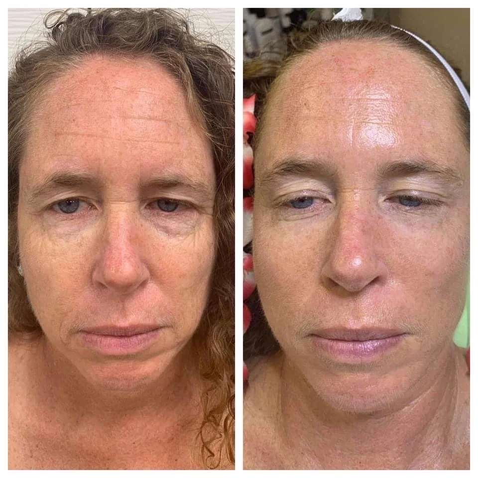 Before and after comparison of skin improvement, showing reduction in acne and clearer complexion on a woman's face.