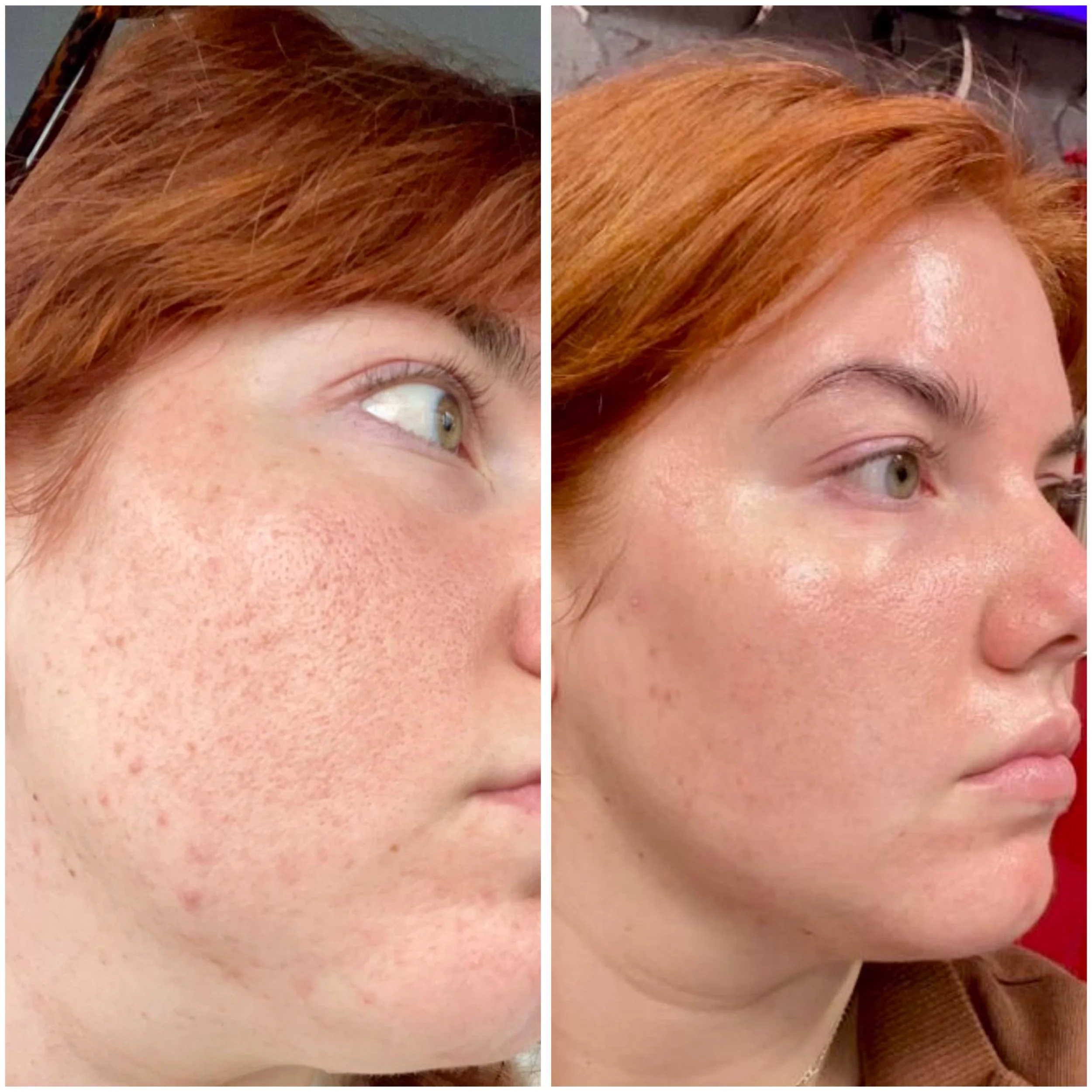 Before and after comparison of skin improvement, showing reduction in acne and clearer complexion on a woman's face.