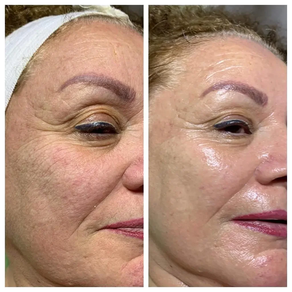 Anti-Aging Facial San Diego