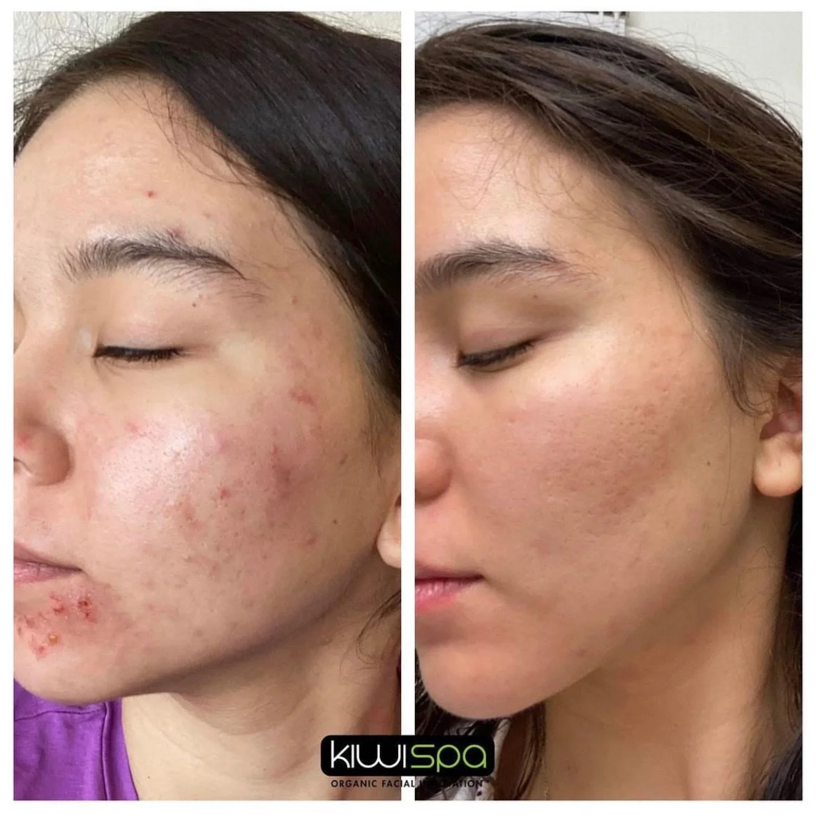 Side by side comparison of before and after photos from acne facial at Kiwi spa Pacific Beach