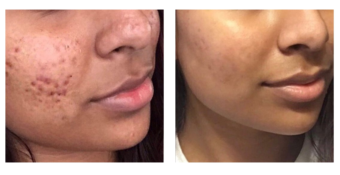 Before and after facial treatment showcasing improved skin texture and reduced wrinkles on an older person.