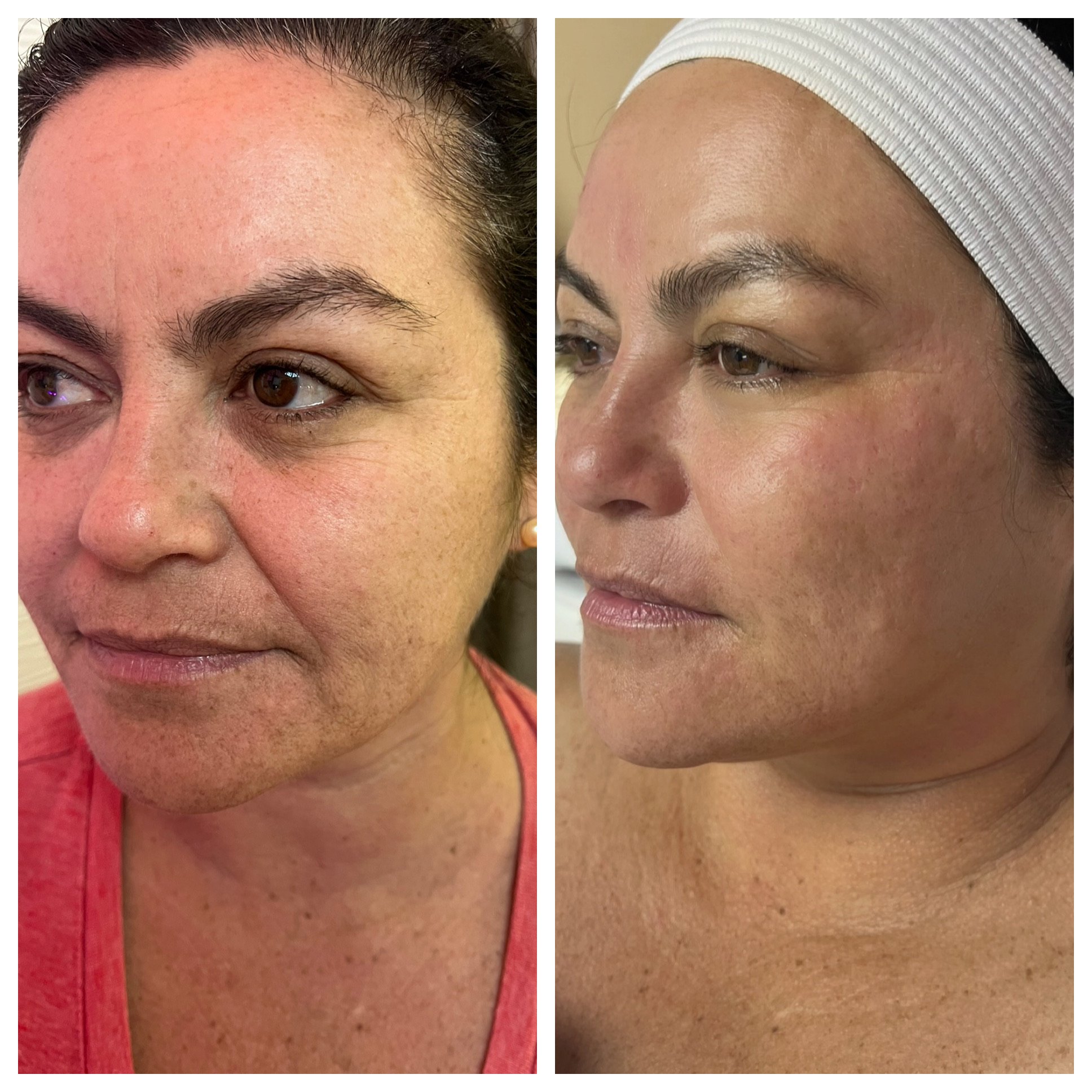 Before and after facial treatment showcasing improved skin texture and reduced wrinkles on an older person.