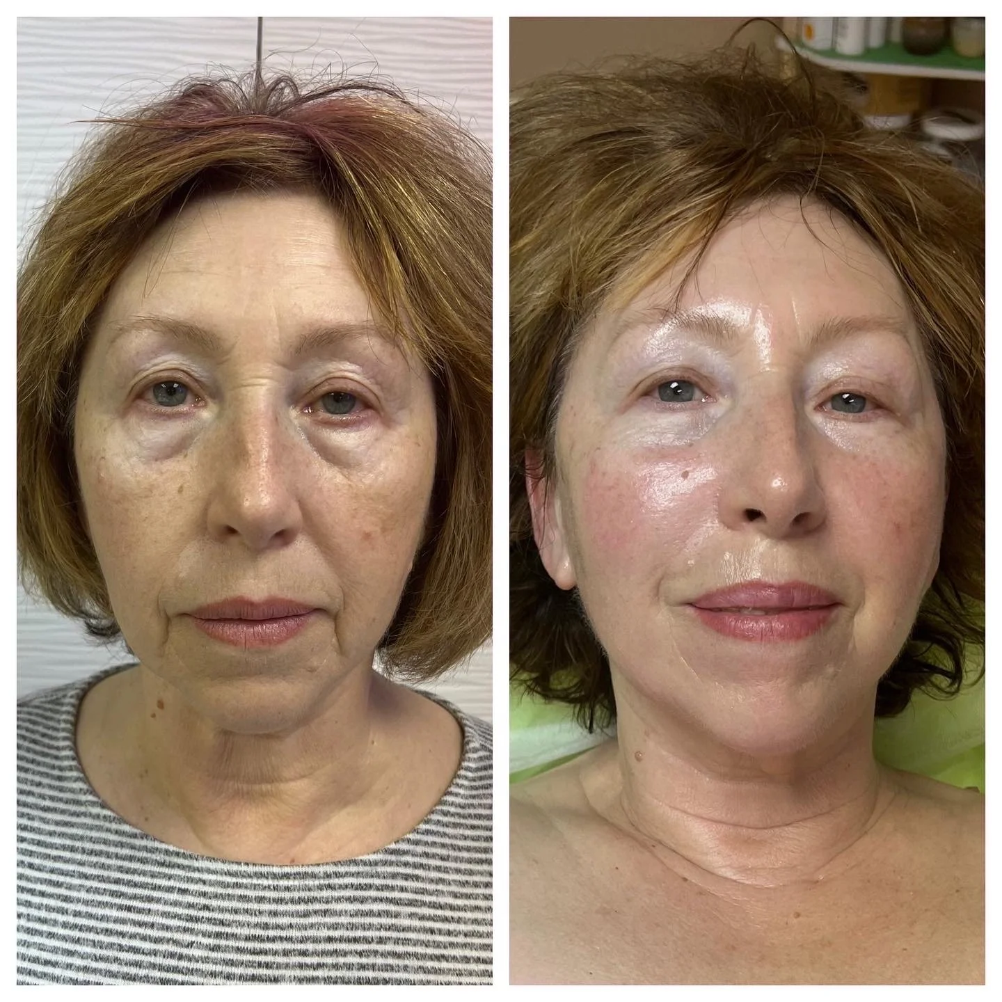 Acne free facial treatment