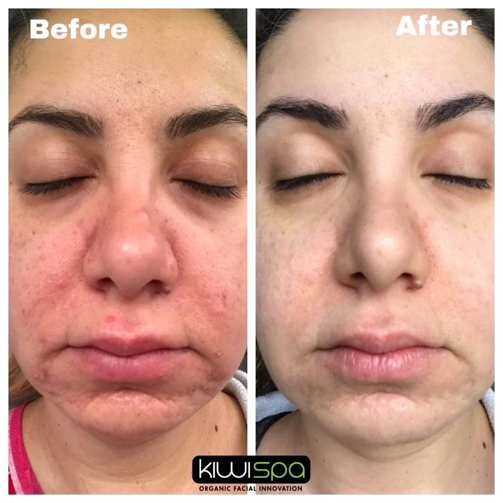 Acne before and after results San Diego