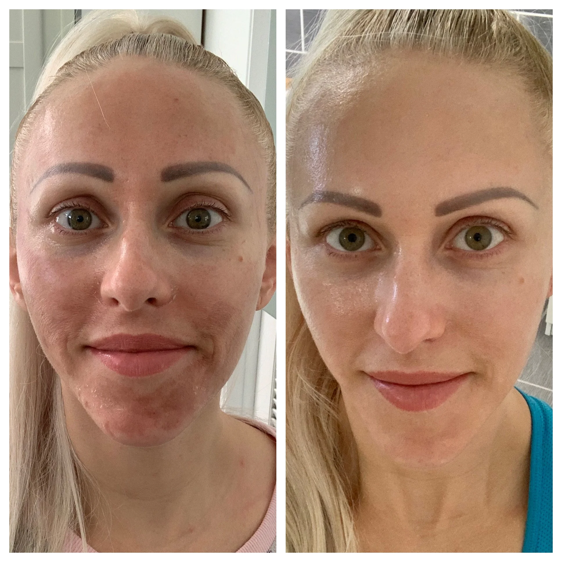 Before and after facial treatment showcasing improved skin texture and reduced wrinkles on an older person.