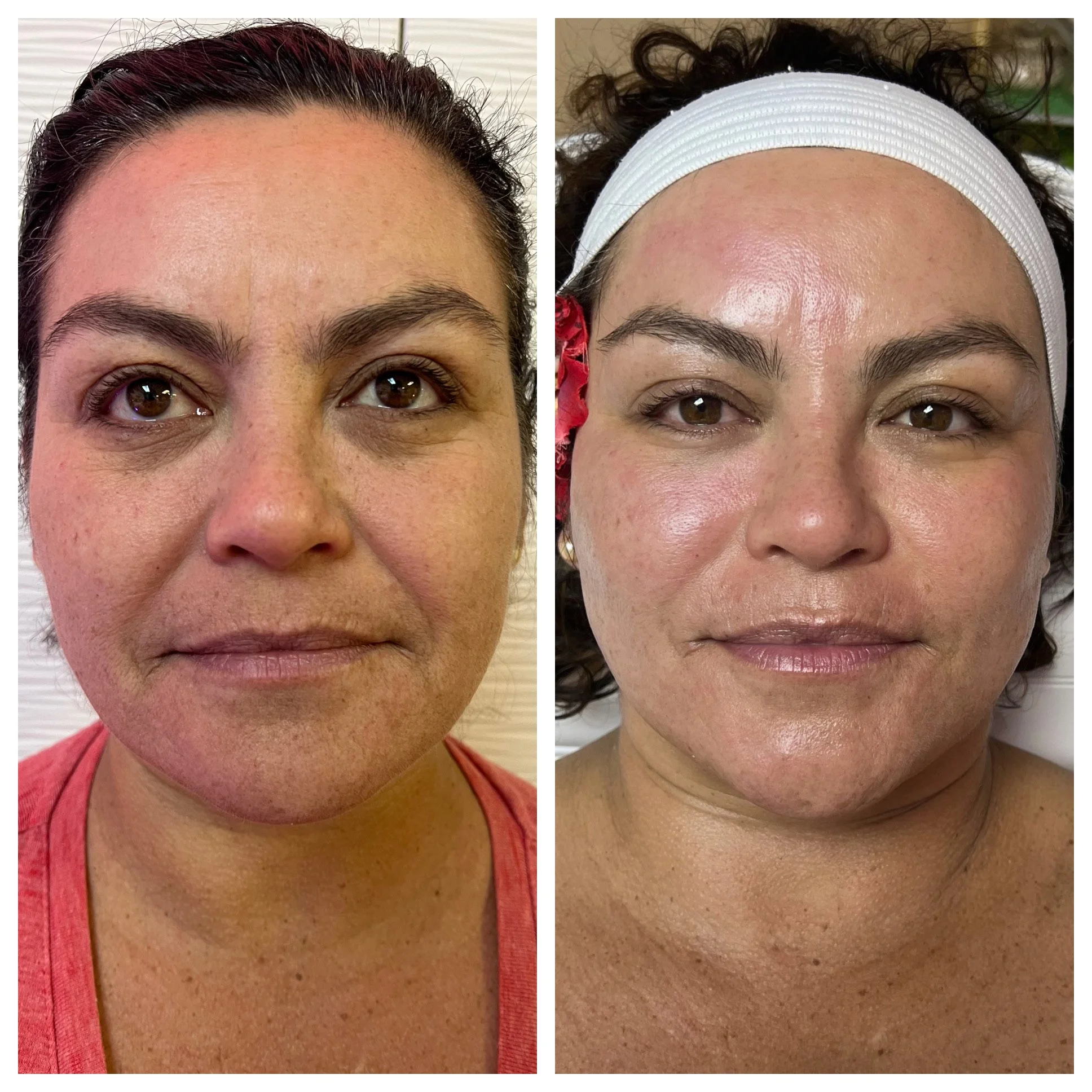 Before and after comparison of a woman's face showing skin improvement, reduced blemishes, and smoother complexion.