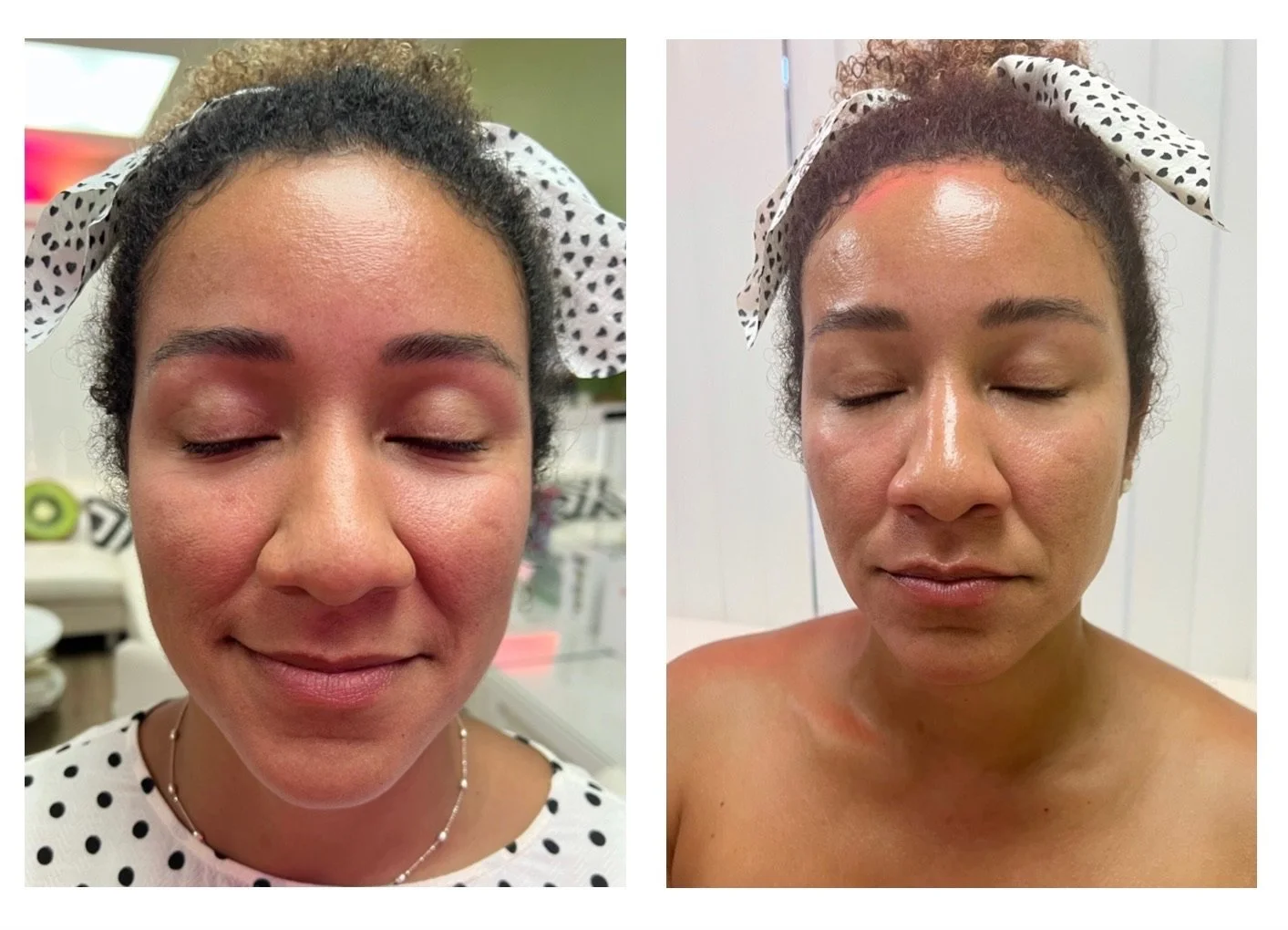 Before and after facial treatment showcasing improved skin texture and reduced wrinkles on an older person.