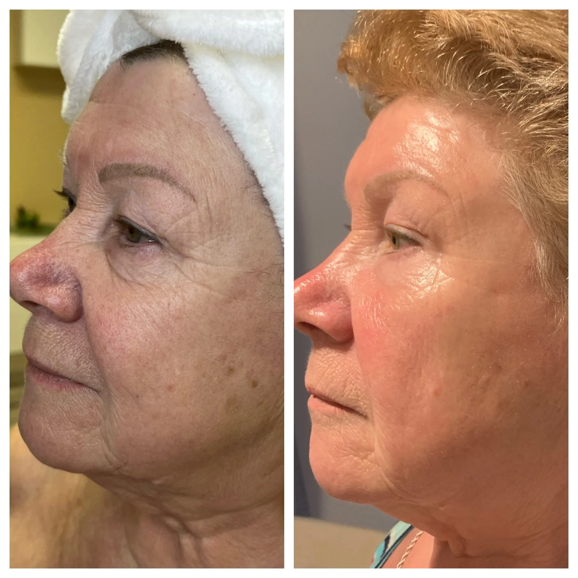 Side-by-side comparison of a woman with noticeable skin issues on the left and clearer skin on the right, showing a beauty or skincare transformation.