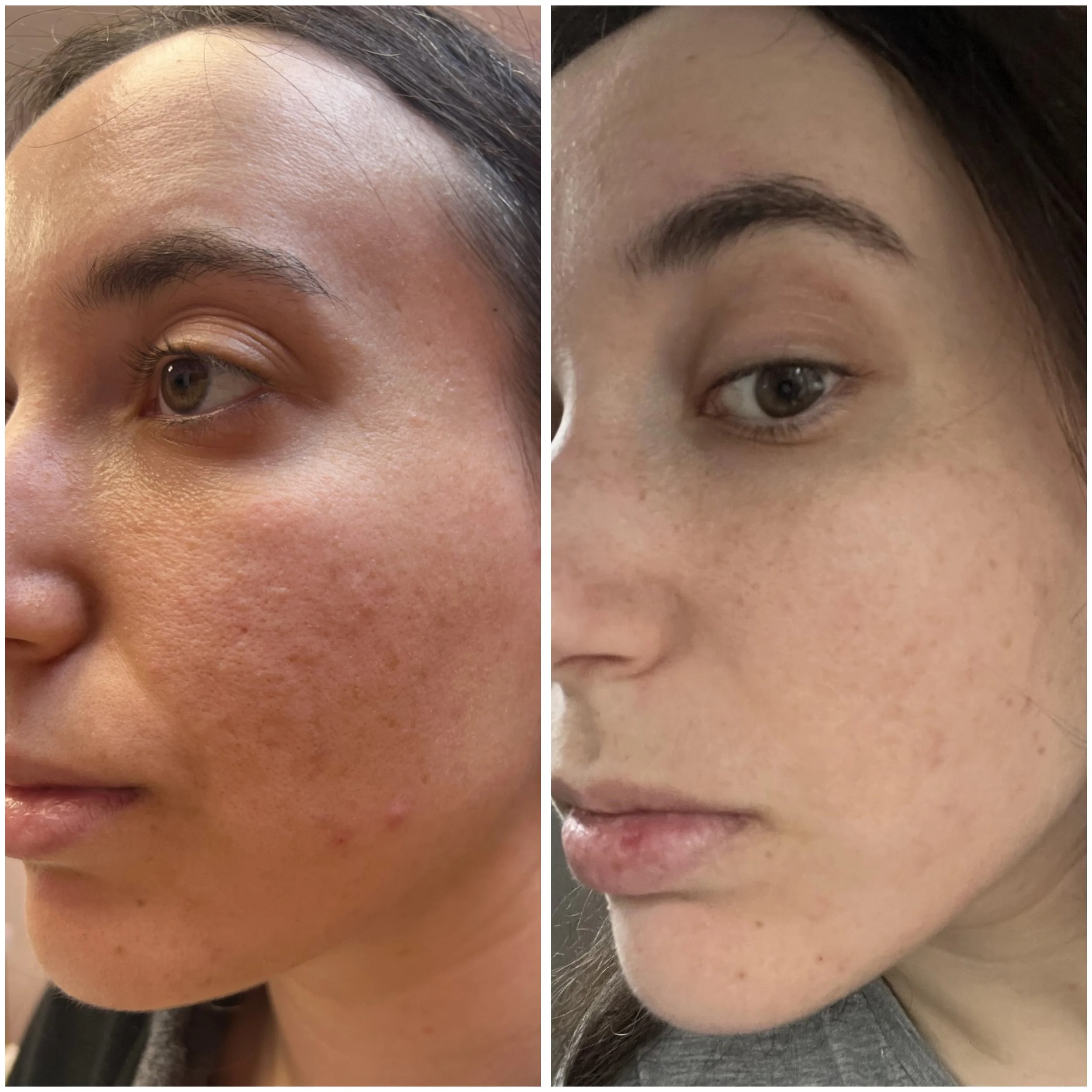 Before and after comparison of skin improvement, showing reduction in acne and clearer complexion on a woman's face.