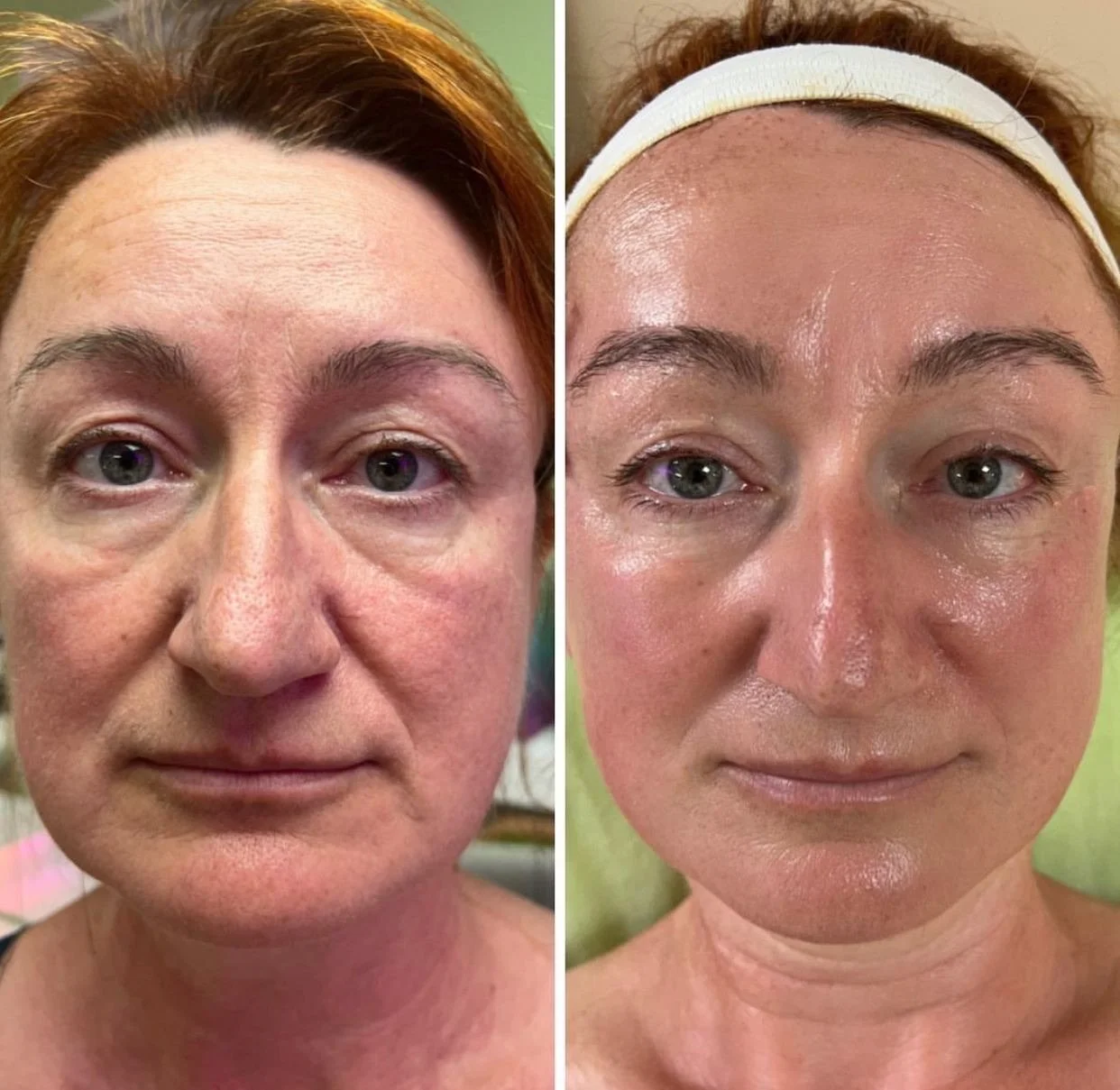 Side-by-side comparison of a woman's face before and after skincare, showing clearer skin and fewer blemishes in the after photo.