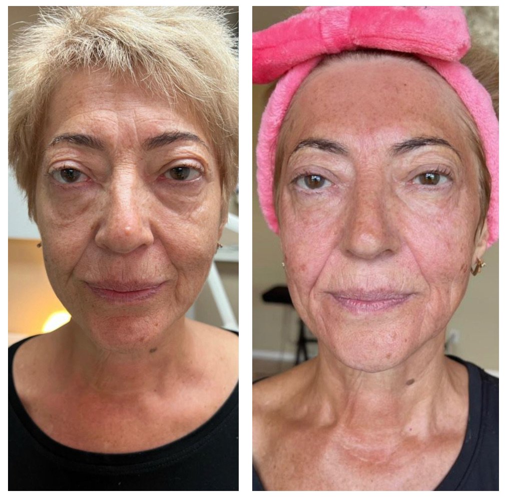 Before and after comparison of a woman's face showing changes in skin tone and texture.