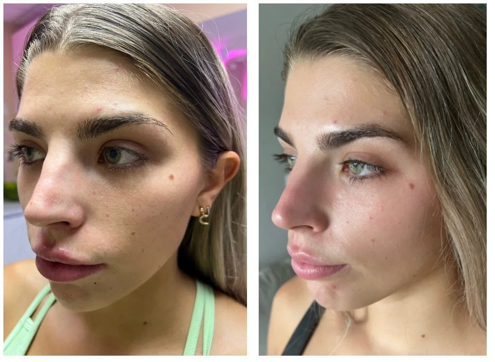 Before and after comparison of skin improvement, showing reduction in acne and clearer complexion on a woman's face.