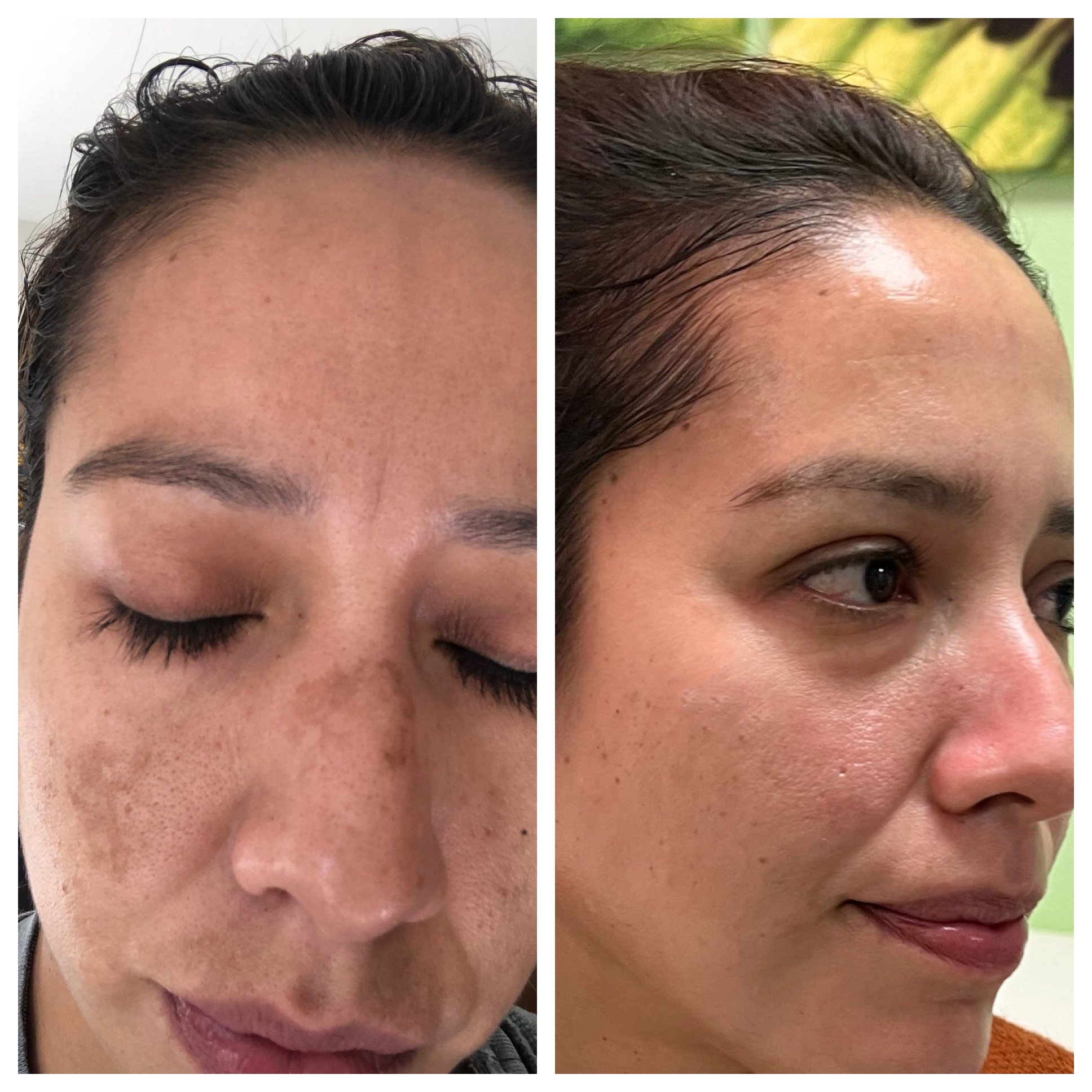 Before and after comparison of skin improvement, showing reduction in acne and clearer complexion on a woman's face.