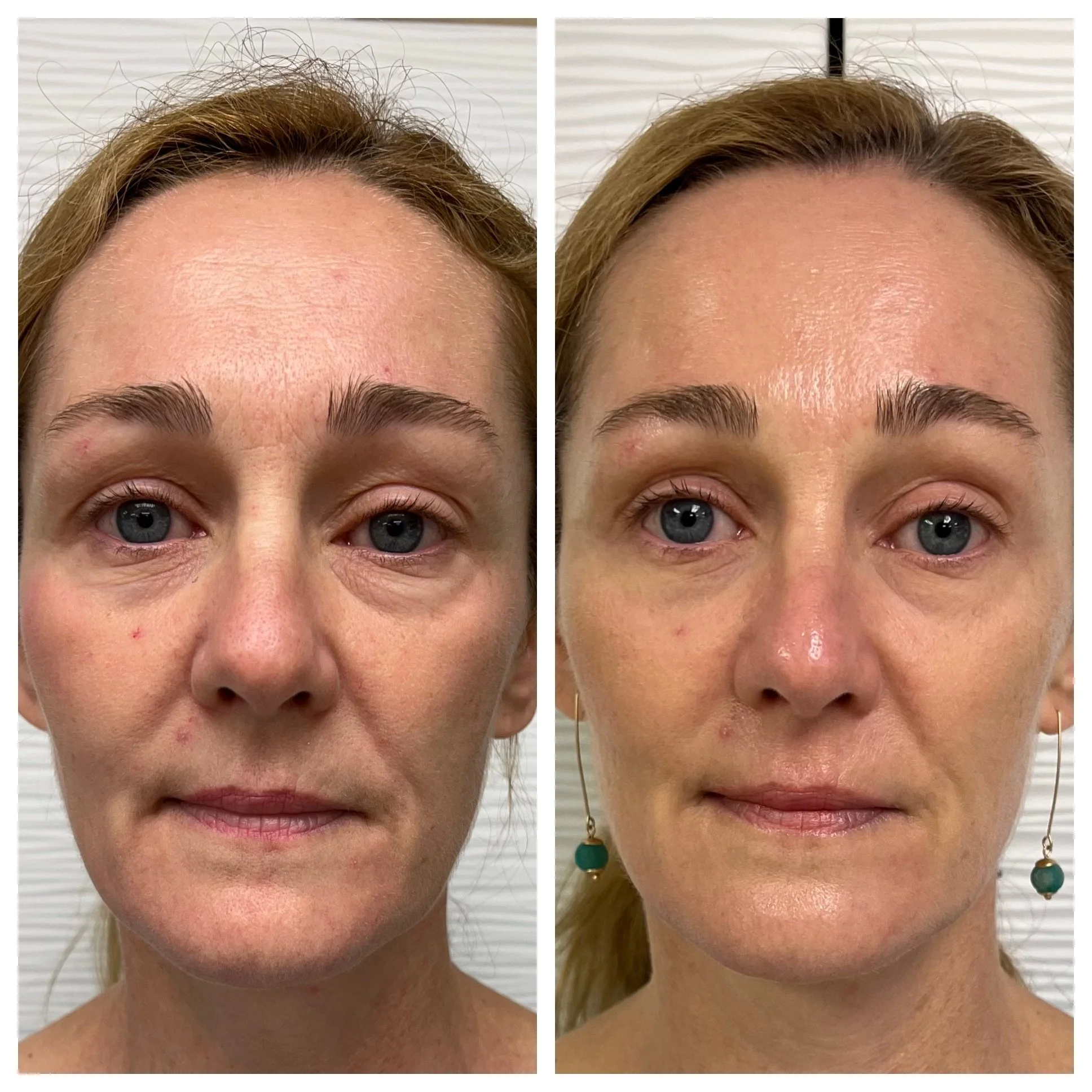 Comparison of a woman's face showing skin with acne scars before and after skin treatment, with clearer skin in the after photo.