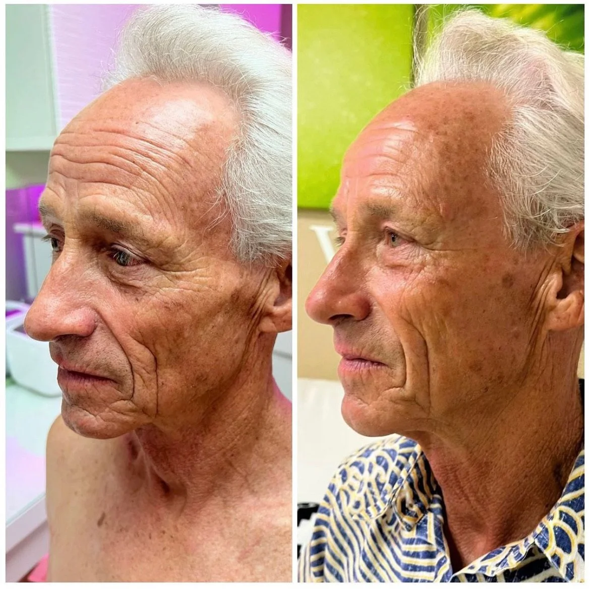 Side-by-side comparison of a man's face before and after a skincare or cosmetic treatment, showing improved skin texture and glow.