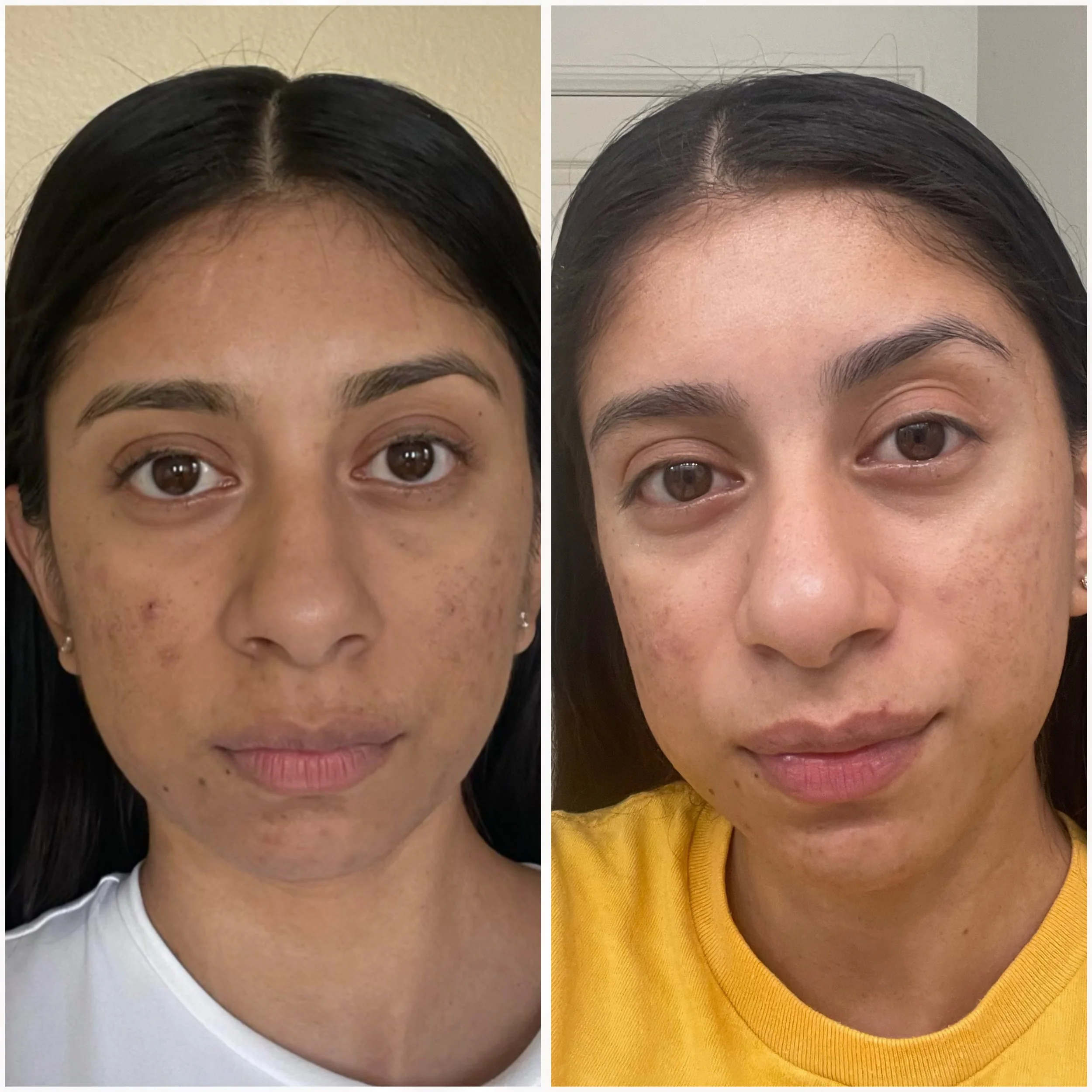 Before and after comparison of a woman's face showing skin improvement, reduced blemishes, and smoother complexion.
