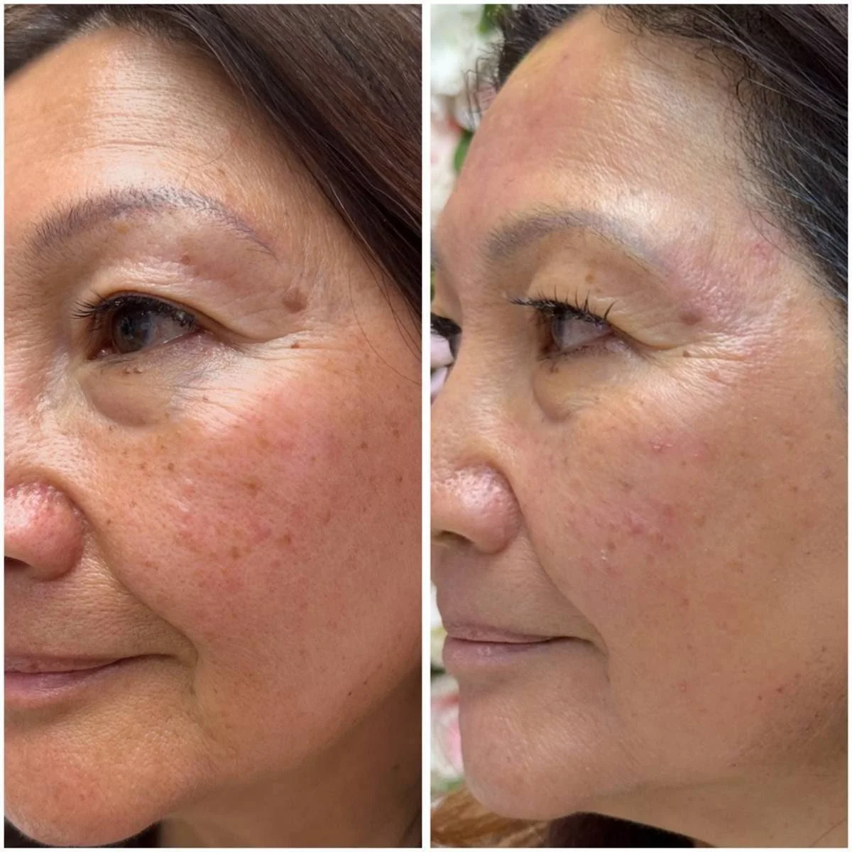 Side-by-side comparison of a woman's face showing skin improvement, with redness and blemishes on the left and clearer skin on the right.