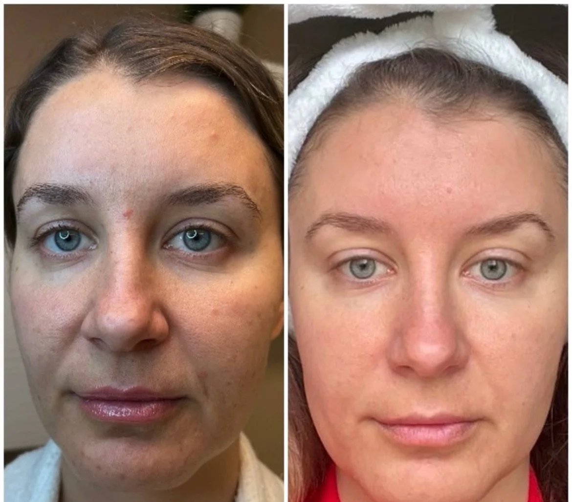 Before and after photo of a client at Kiwi Spa