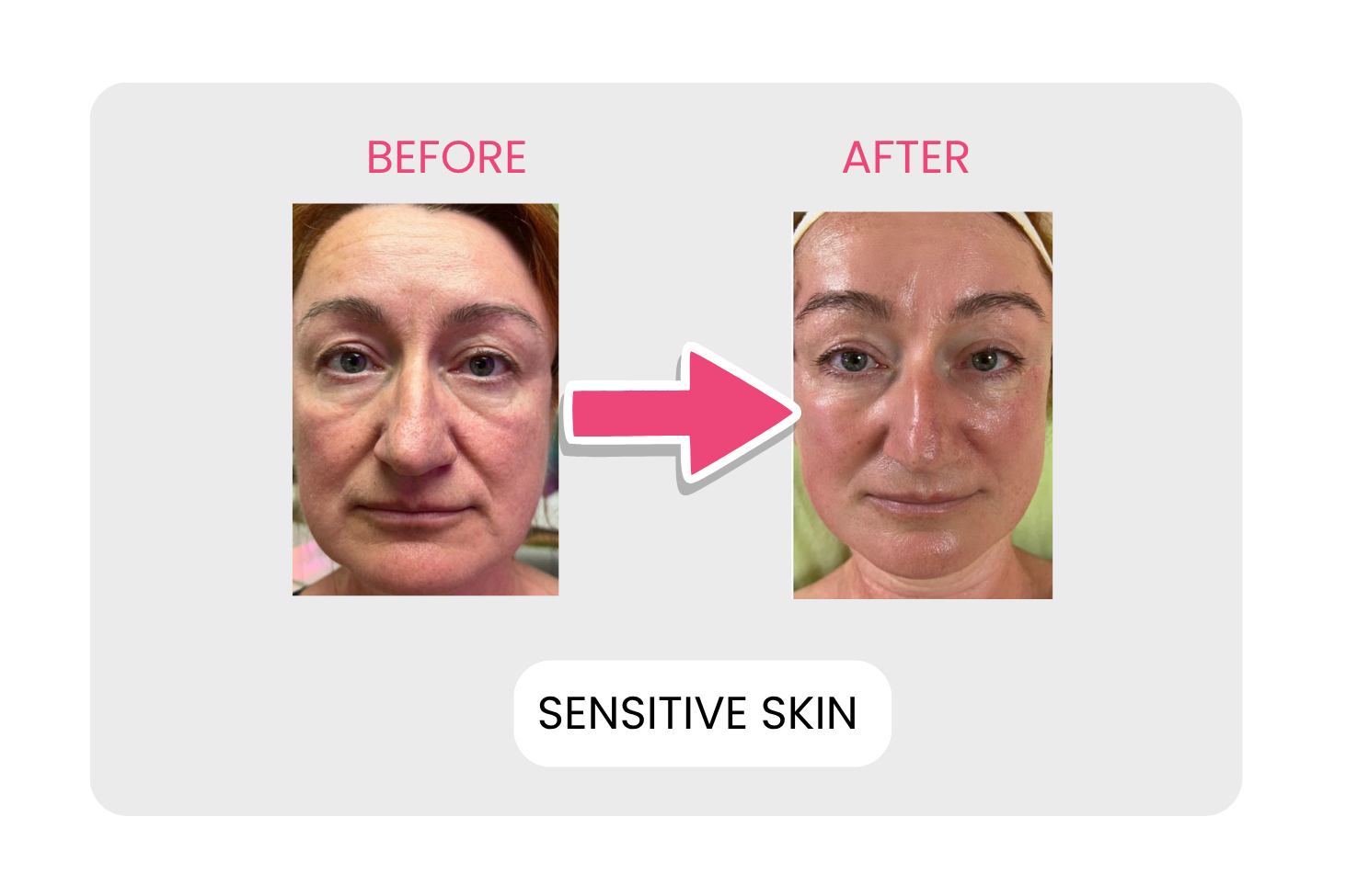 Sensitive skin before and after