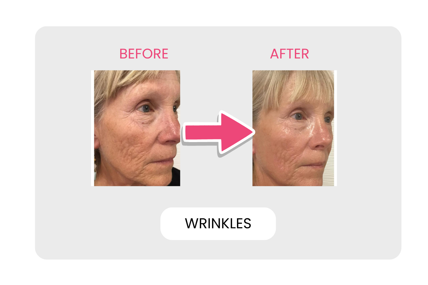 Wrinkles before and after