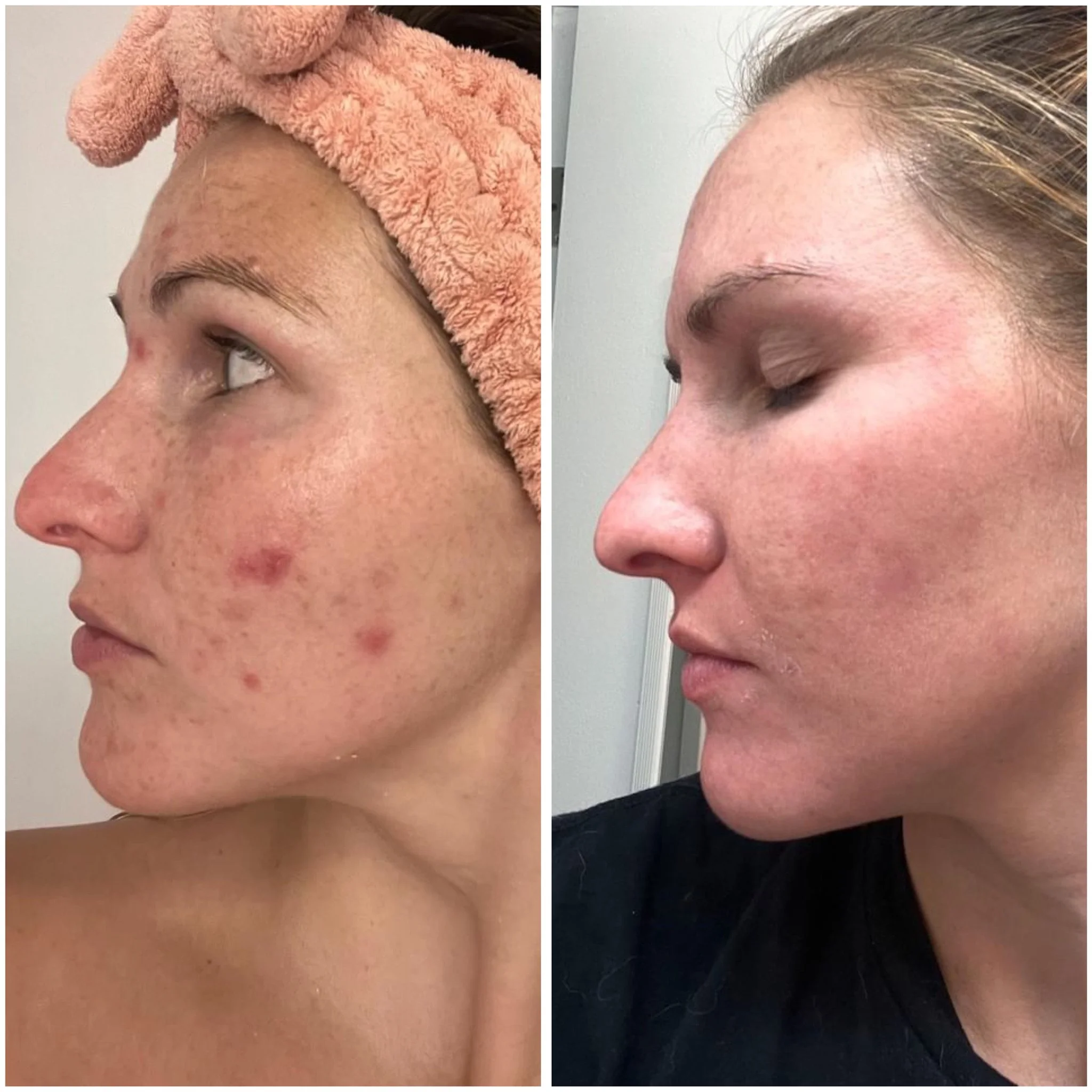 Before and after comparison at Kiwi Spa San Diego acne facial