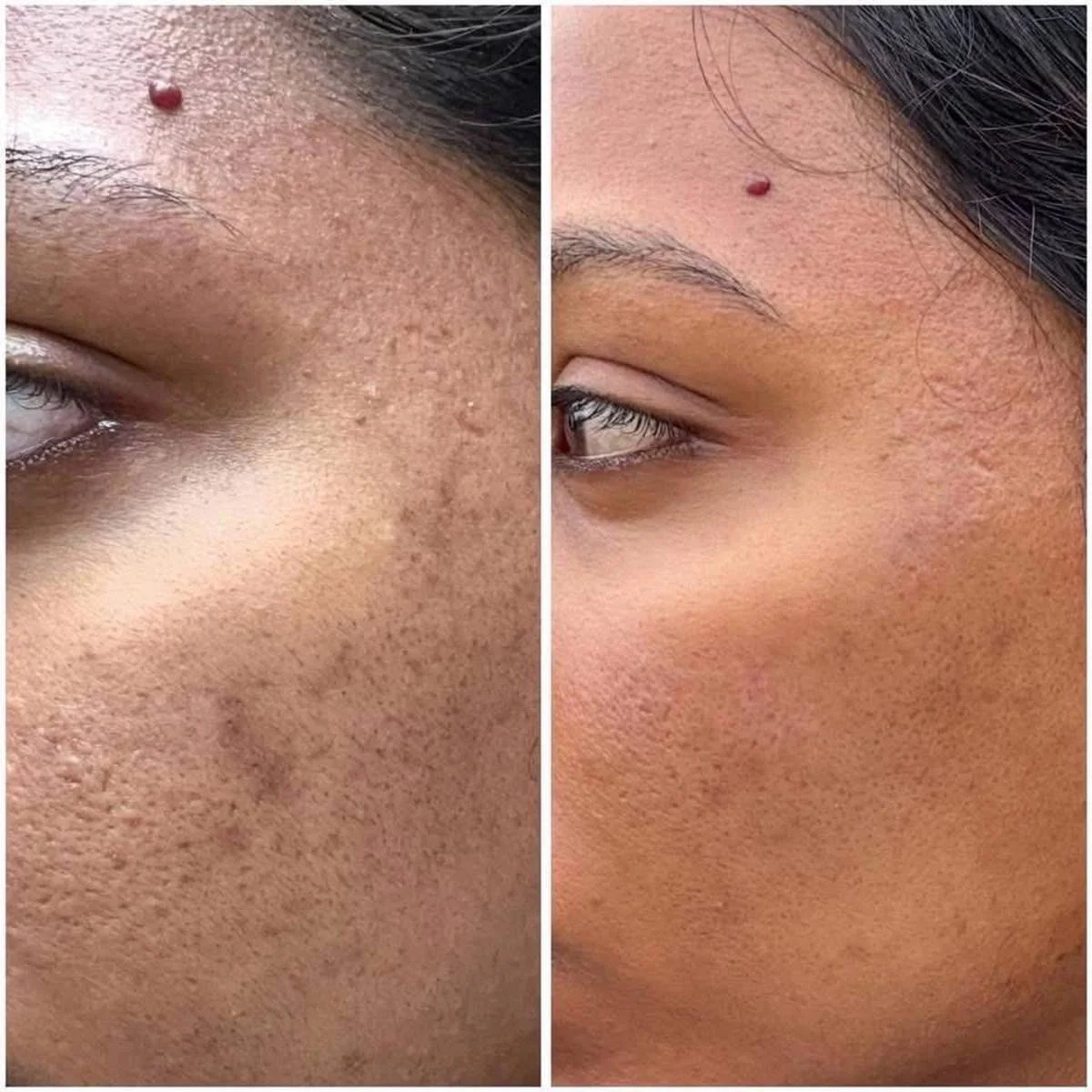 Before and after facial treatment showcasing improved skin texture and reduced wrinkles on an older person.
