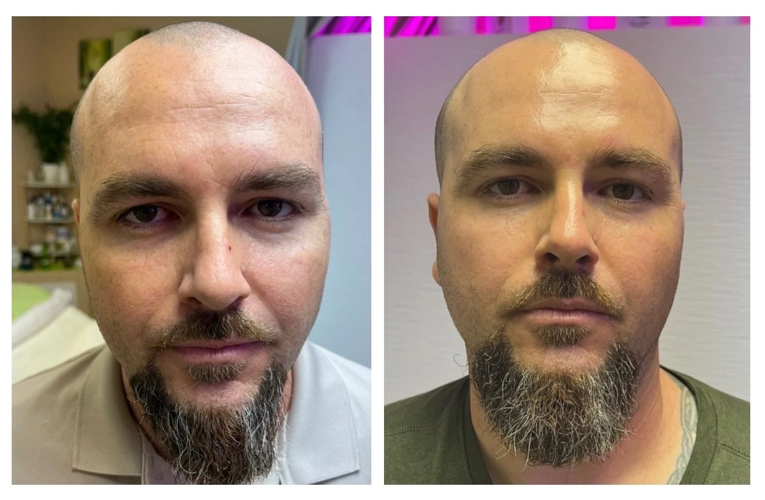 Side-by-side comparison of a woman's face showing skin improvement, with redness and blemishes on the left and clearer skin on the right.