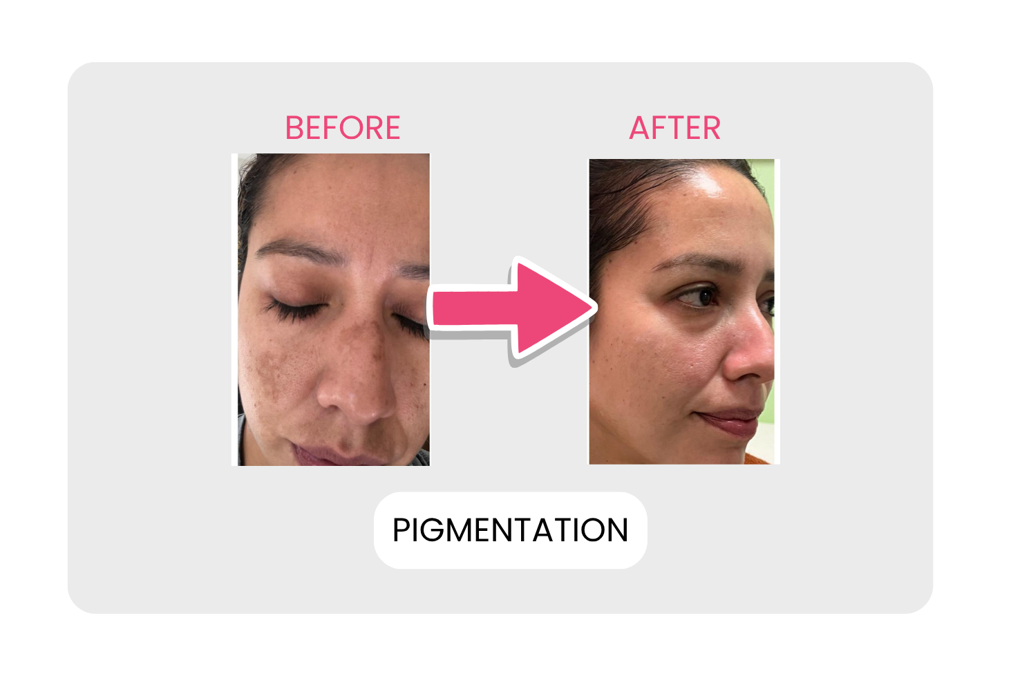 Pigmentation before and after