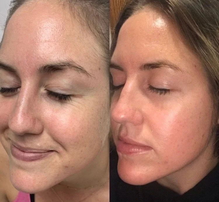 Before and after comparison of a woman's face showing changes in skin tone and texture.