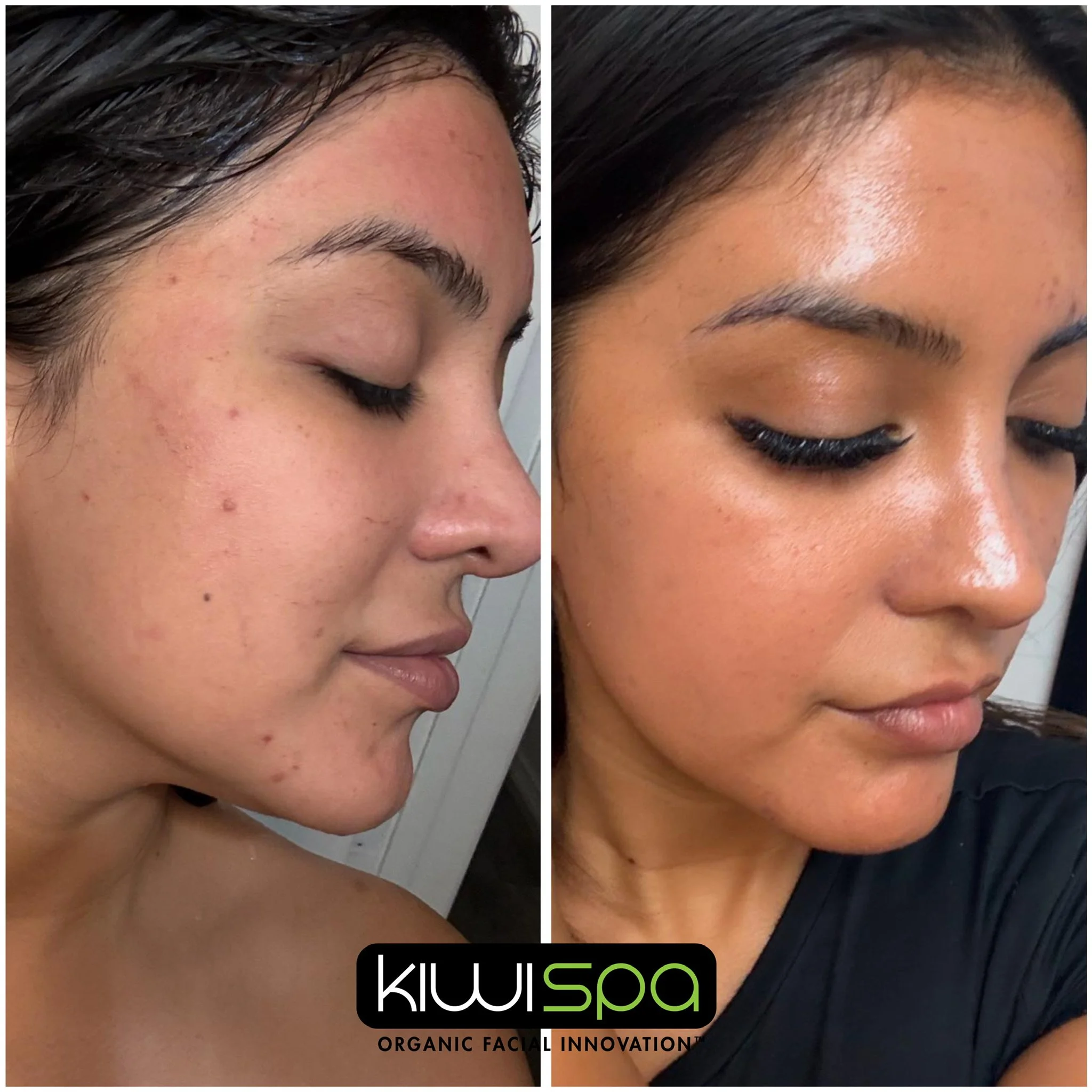 Acne results at Kiwi Spa