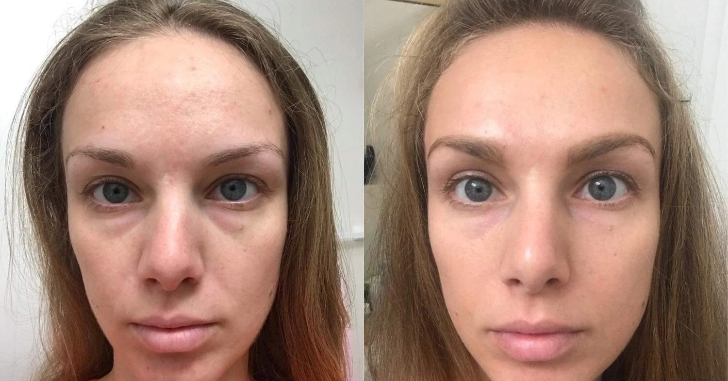 Before and after comparison of a woman's face showing skin improvement, reduced blemishes, and smoother complexion.