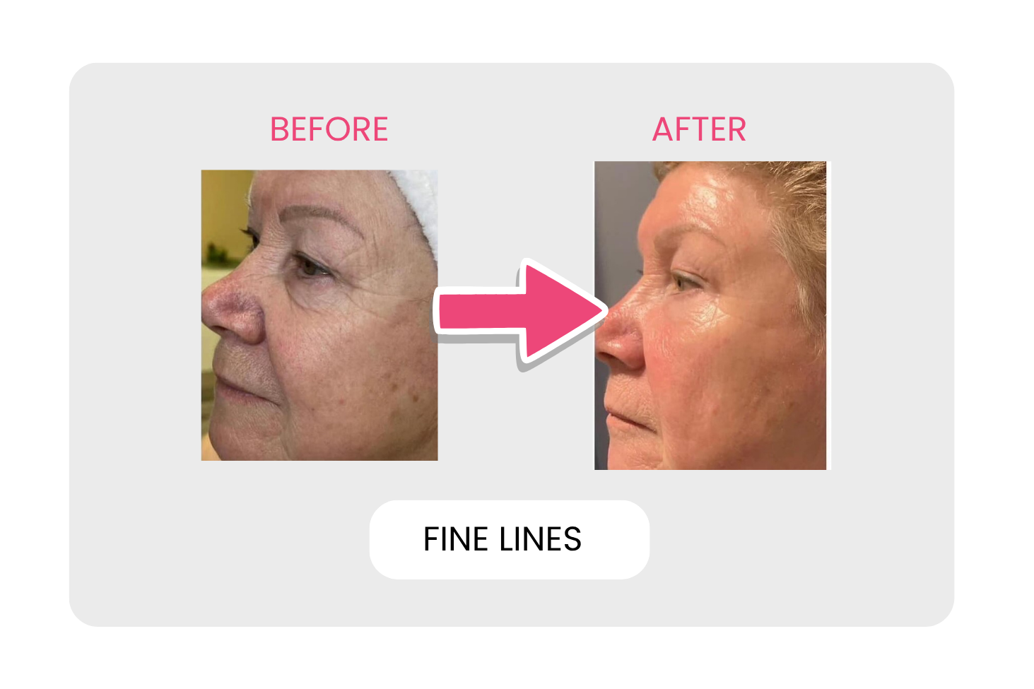 Fine lines before and after