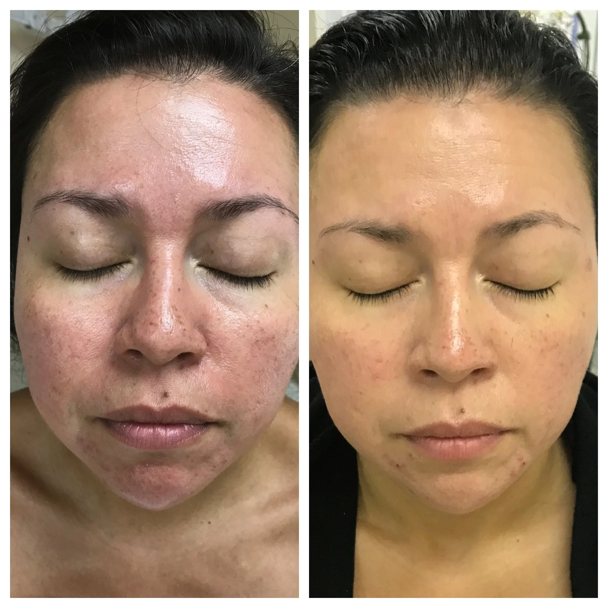 Before and after comparison of a woman's face showing changes in skin tone and texture.