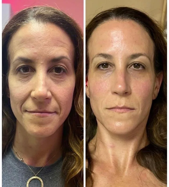 Side-by-side comparison of a woman with noticeable skin issues on the left and clearer skin on the right, showing a beauty or skincare transformation.