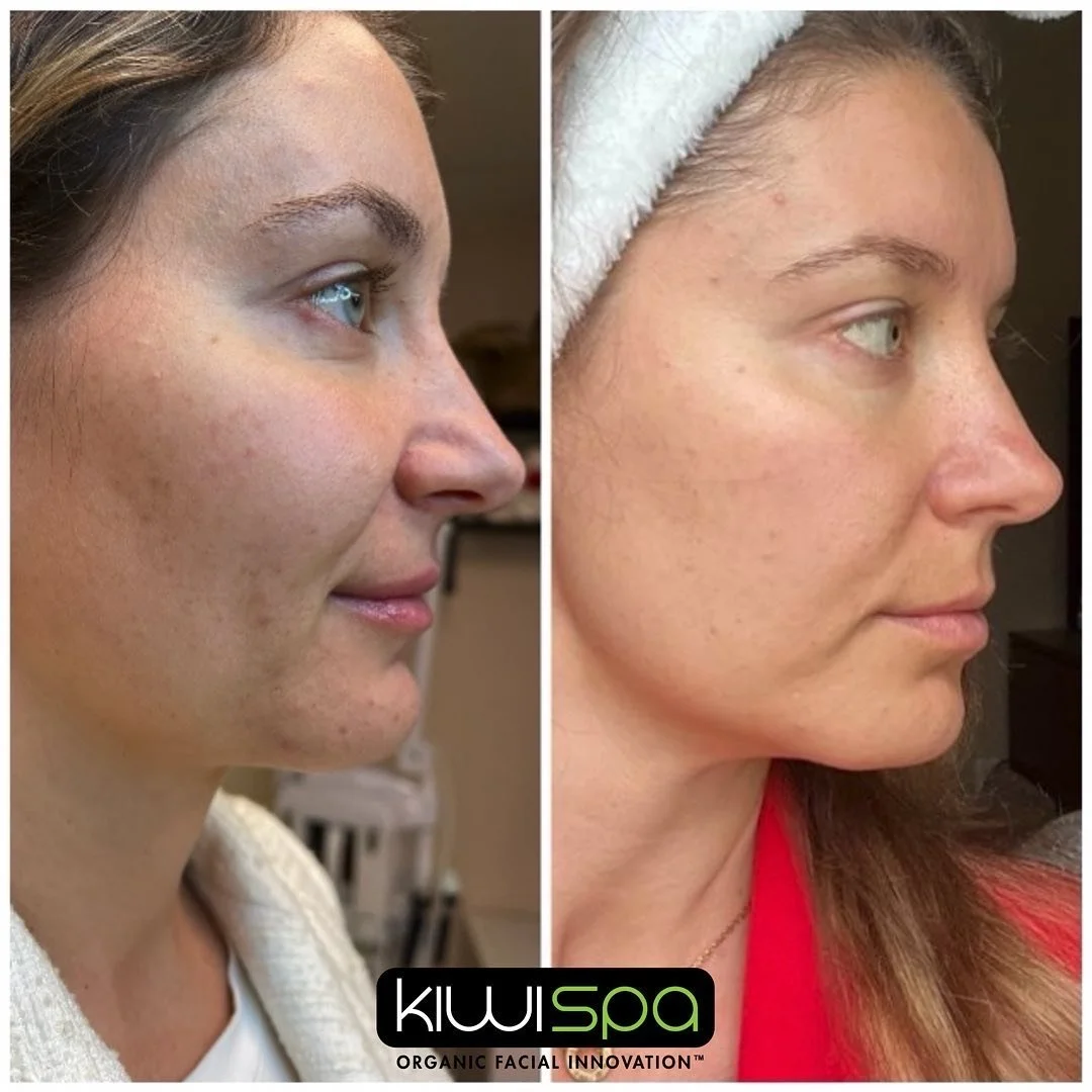 Before and after comparison of a woman's face showing changes in skin tone and texture.