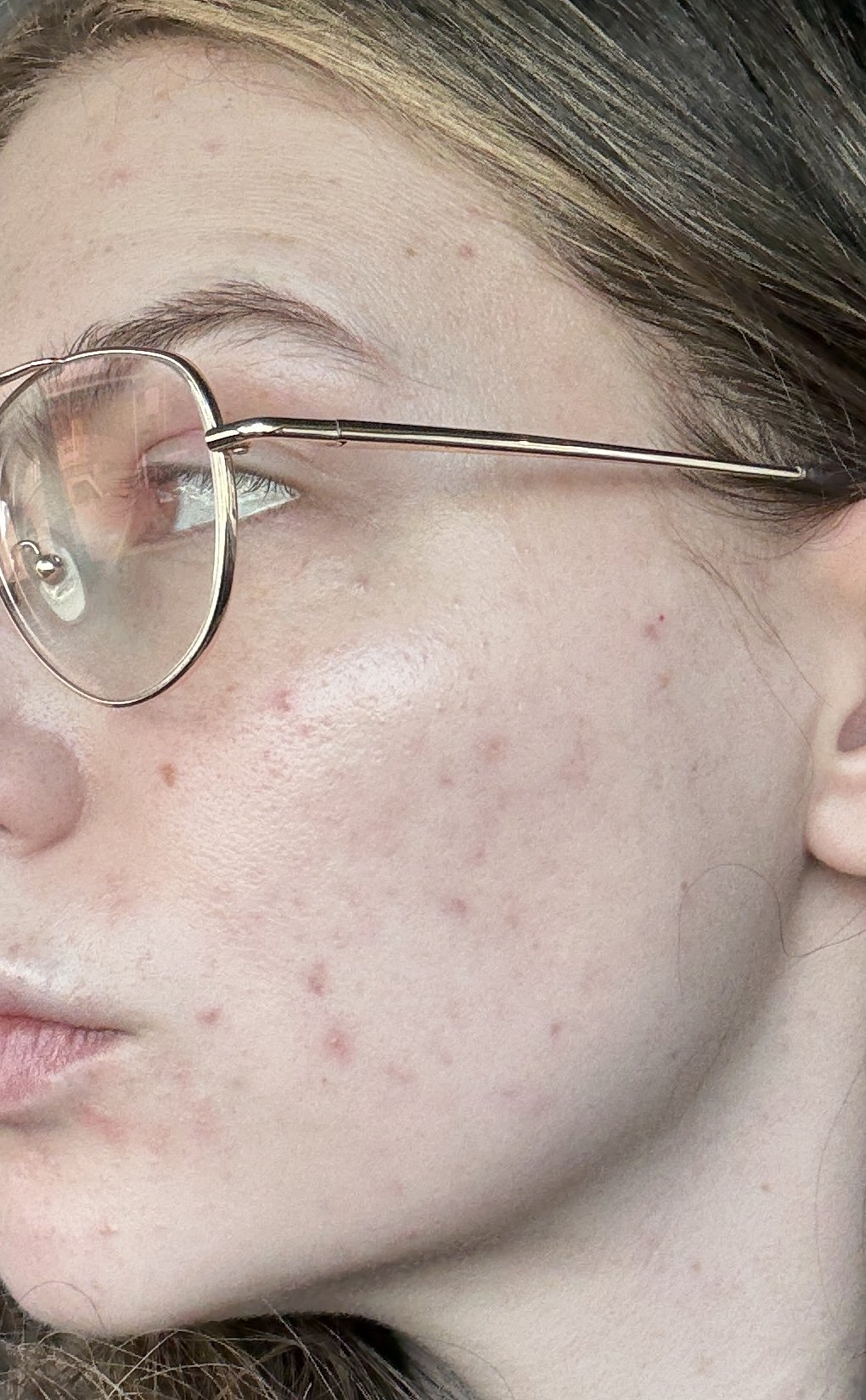 Close-up of skin in January 2026 showing reduced inflammation and healing acne marks.