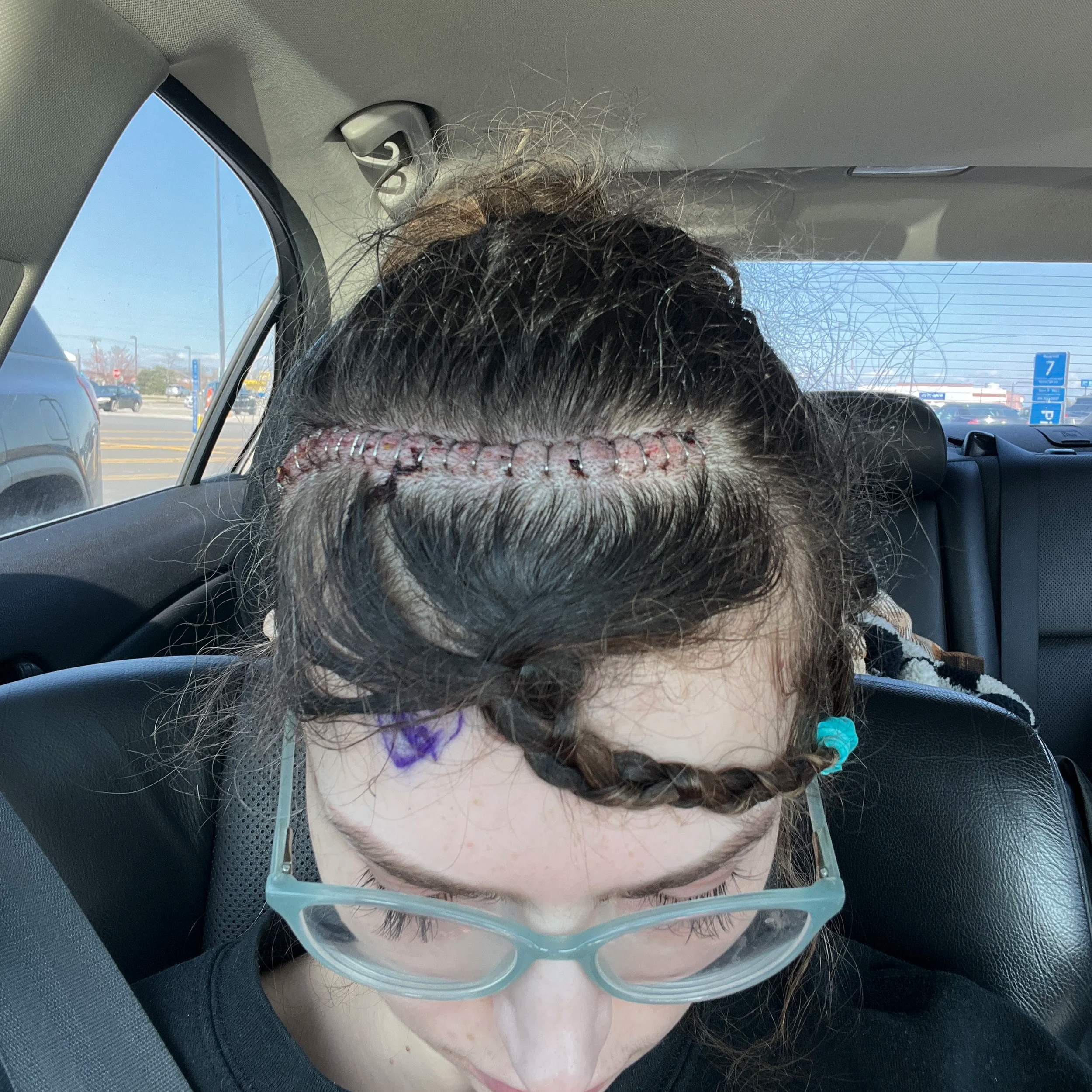 Post-surgery scalp incision with staples following vascular malformation removal in April 2025.