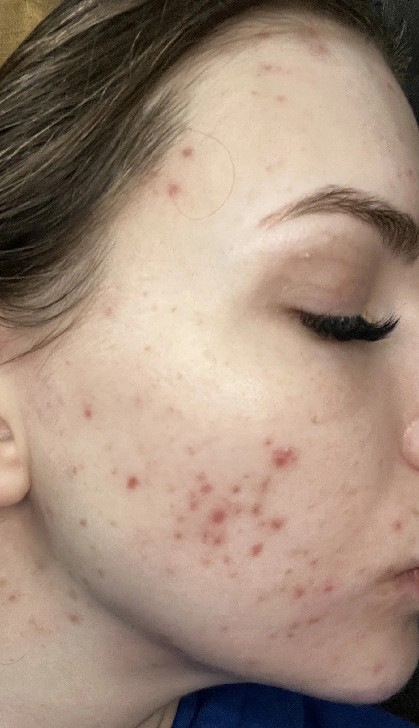 Close-up of persistent inflammatory acne lesions during hormonal instability in 2025.